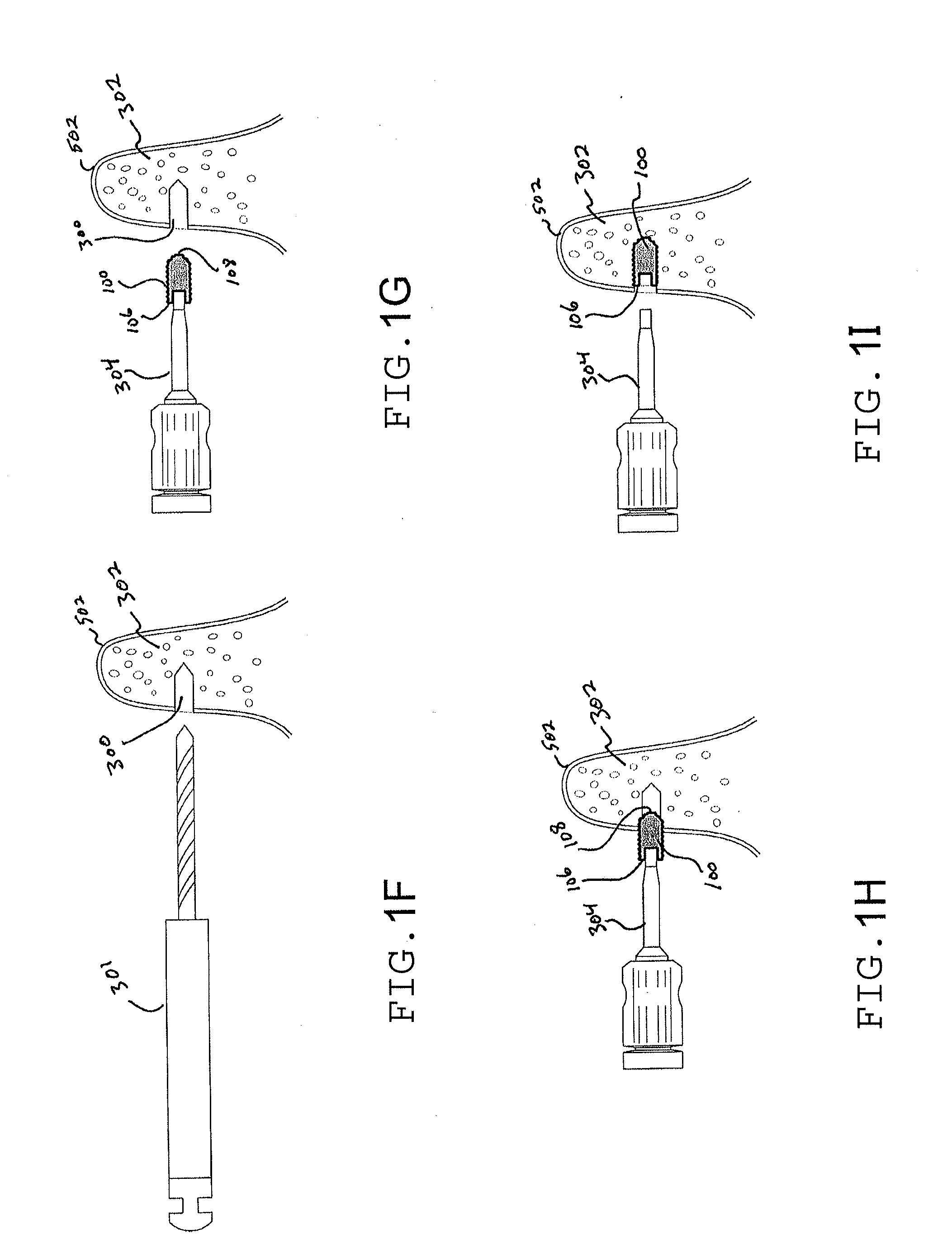 Implant Tack and Methods of Use Thereof