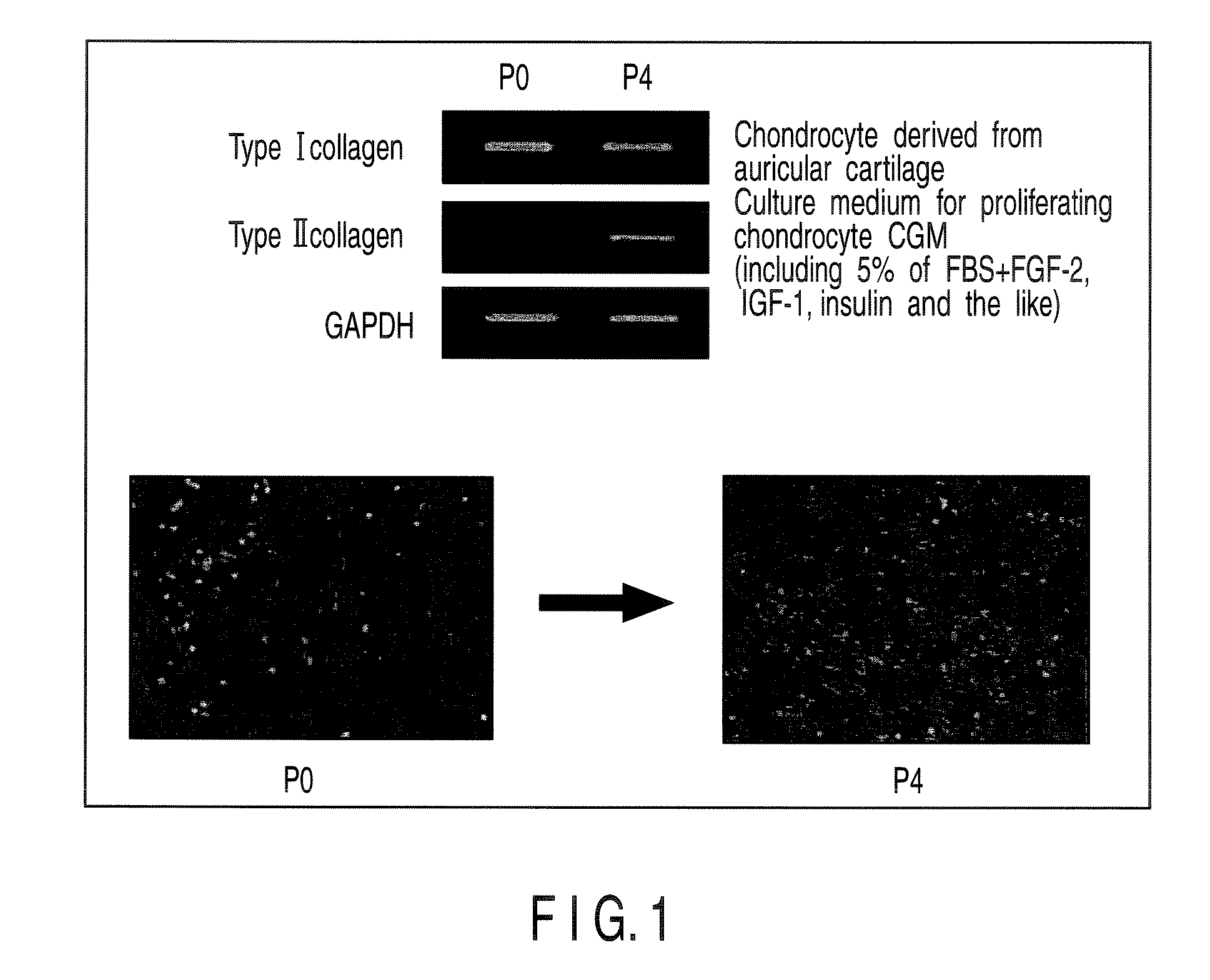 Redifferentiation medium for making dedifferentiated chondrocyte to be redifferentiated into chondrocyte