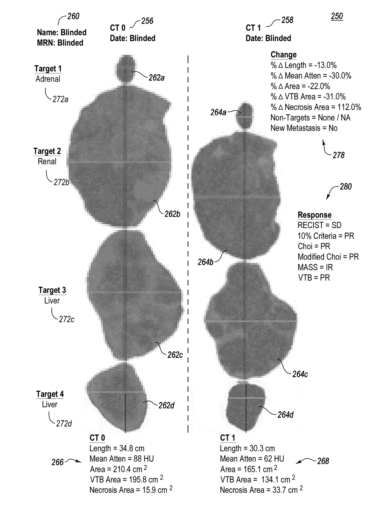 Computer-Assisted Tumor Response Assessment and Evaluation of the Vascular Tumor Burden