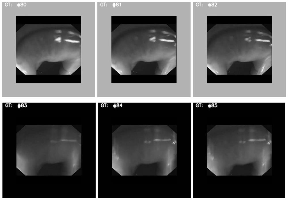 Esophageal endoscope video frame sequence quality classification algorithm using space-time information of adjacent frames