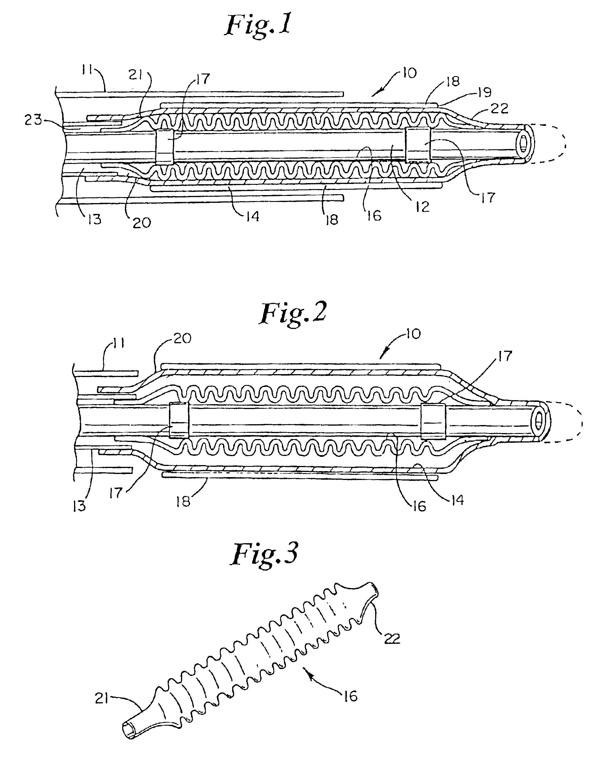 Balloon catheter with stent securement means