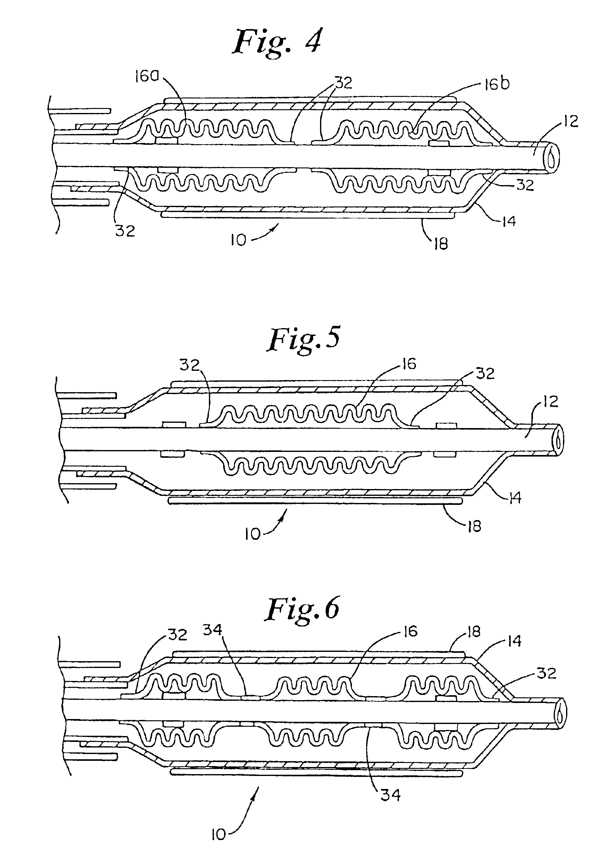 Balloon catheter with stent securement means