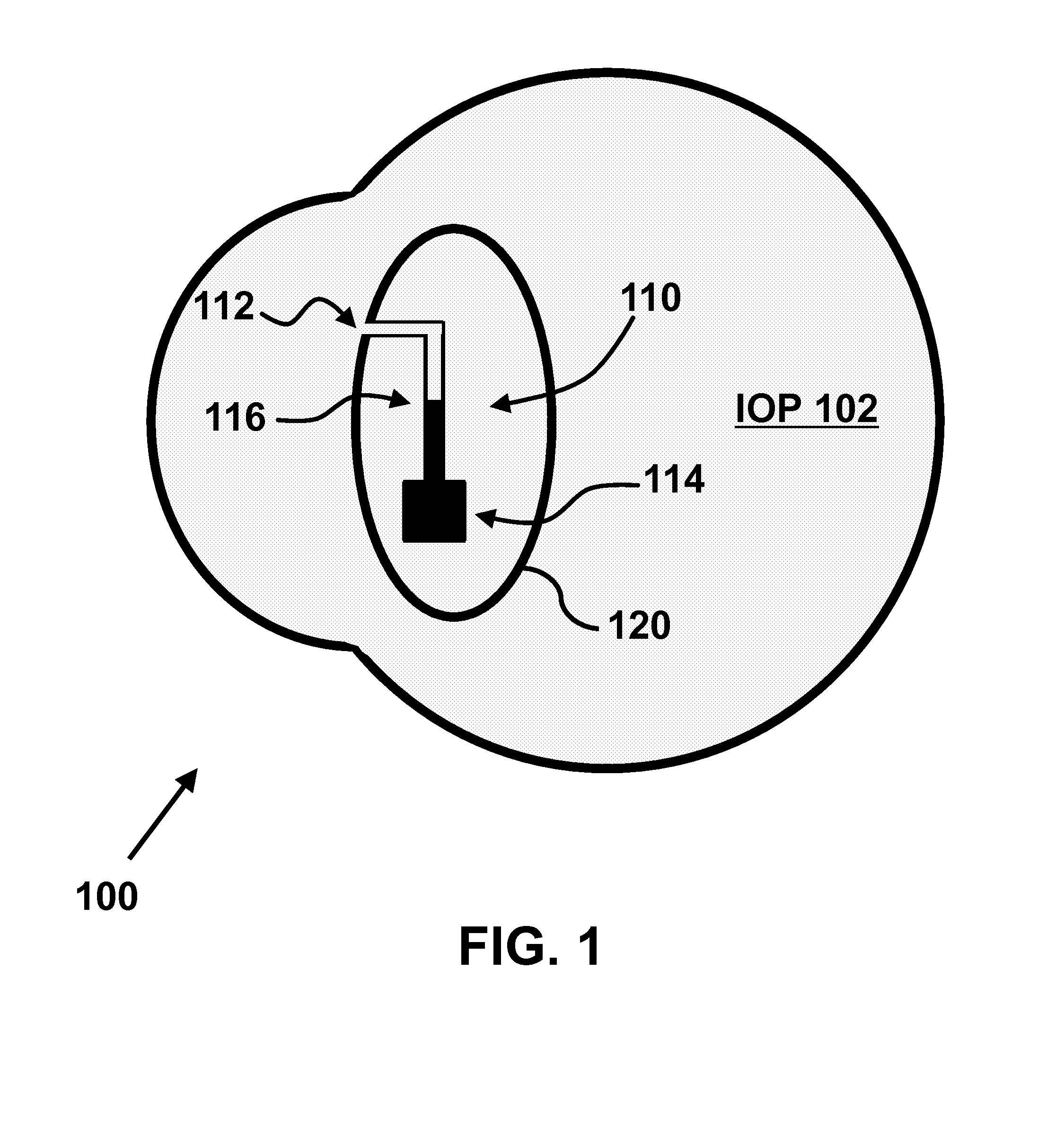 Implantable Micro-Fluidic Device for Monitoring of Intra-Ocular Pressure