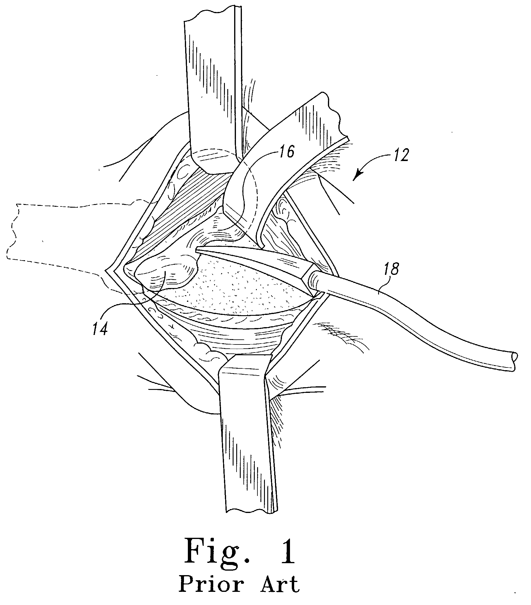 Method and apparatus for use in the performance of endoscopic minimally invasive orthopaedic plating procedures