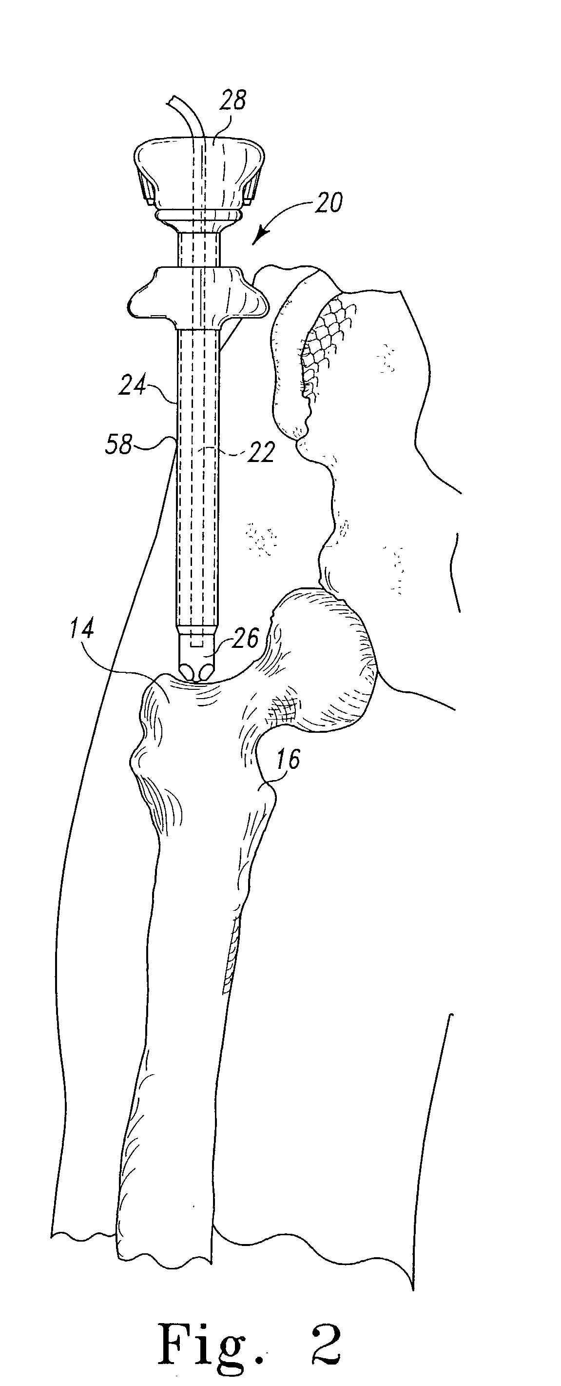 Method and apparatus for use in the performance of endoscopic minimally invasive orthopaedic plating procedures