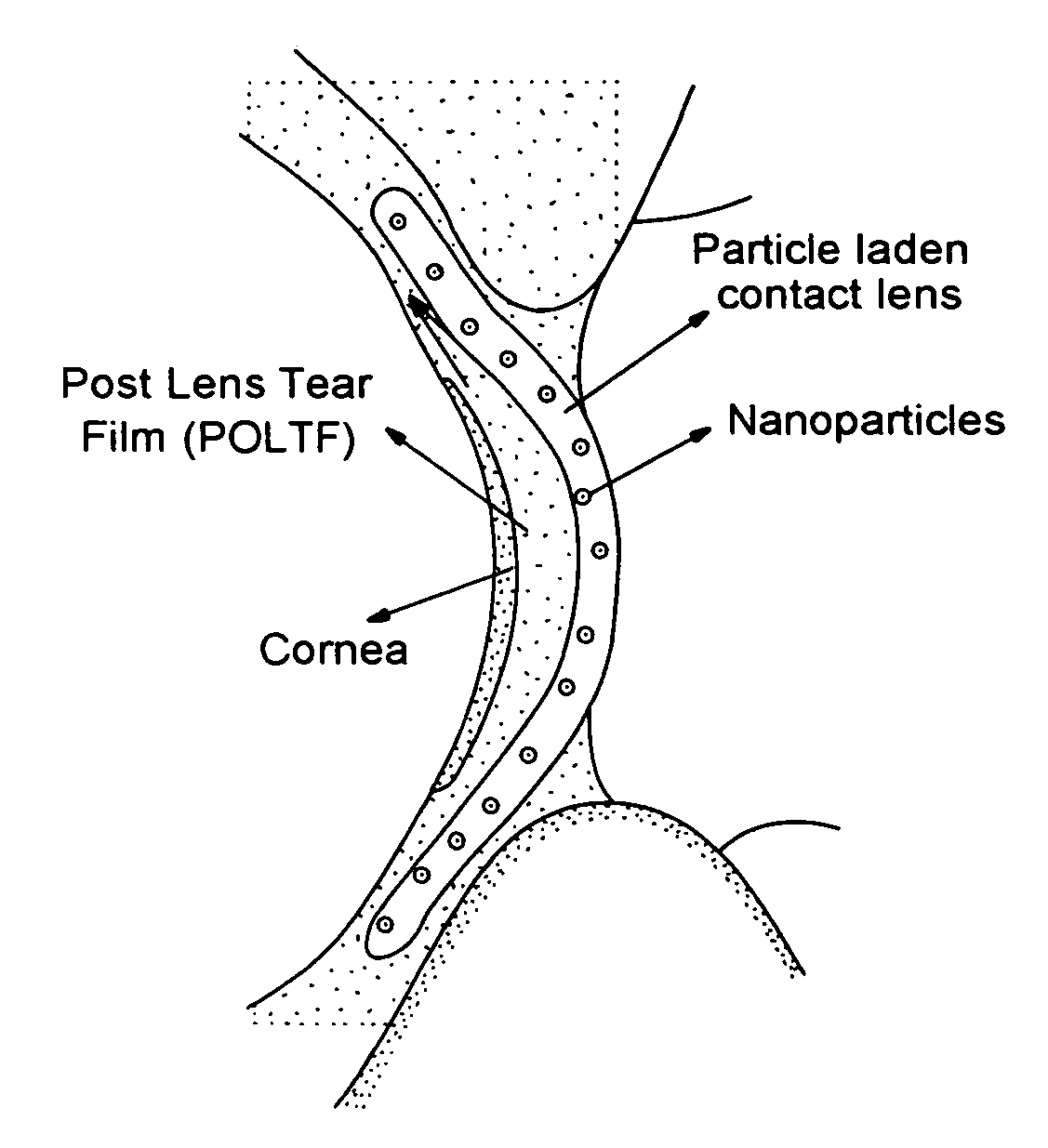 Ophthalmic drug delivery system