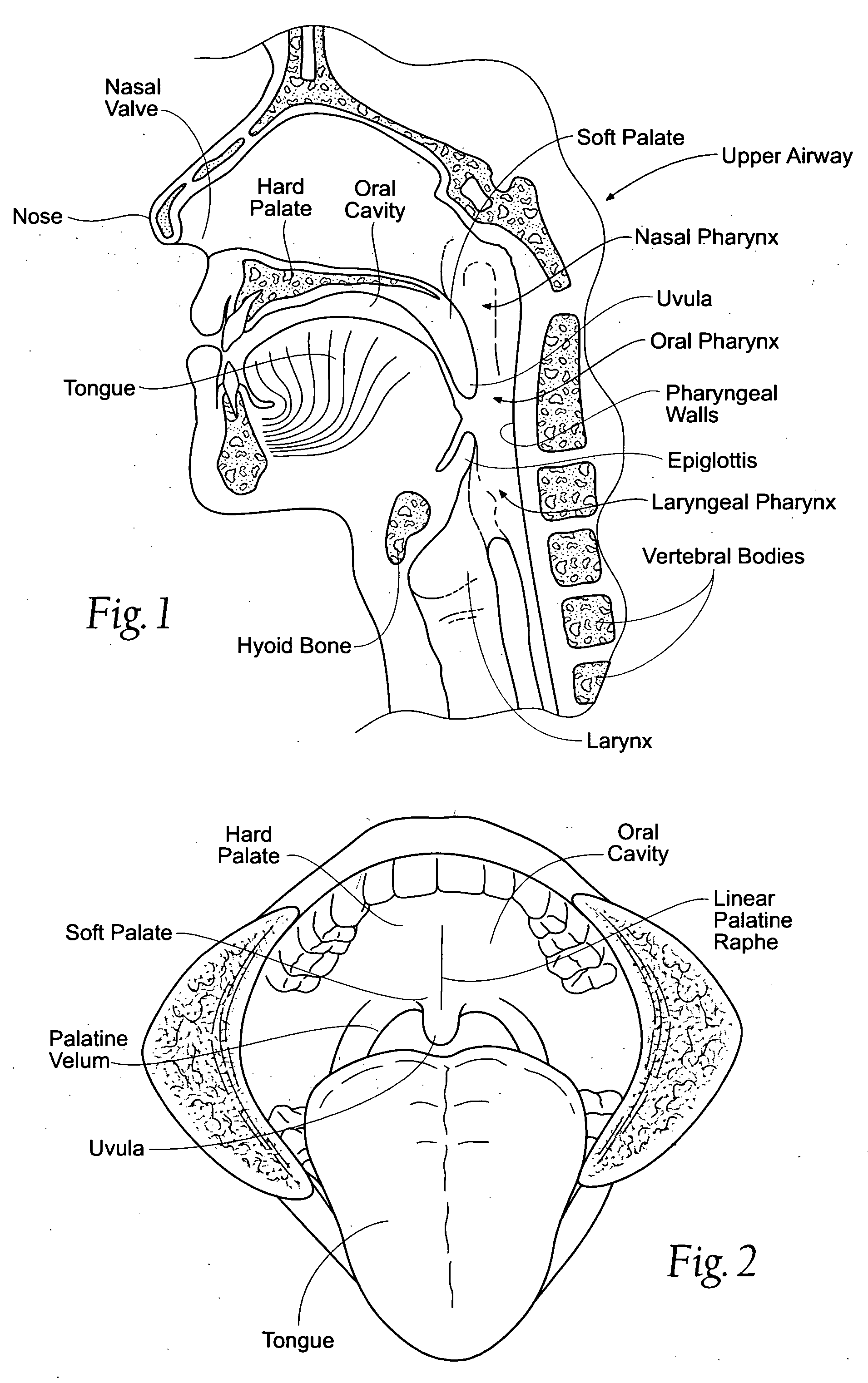 Devices, systems, and methods using magnetic force systems in or on soft palate tissue