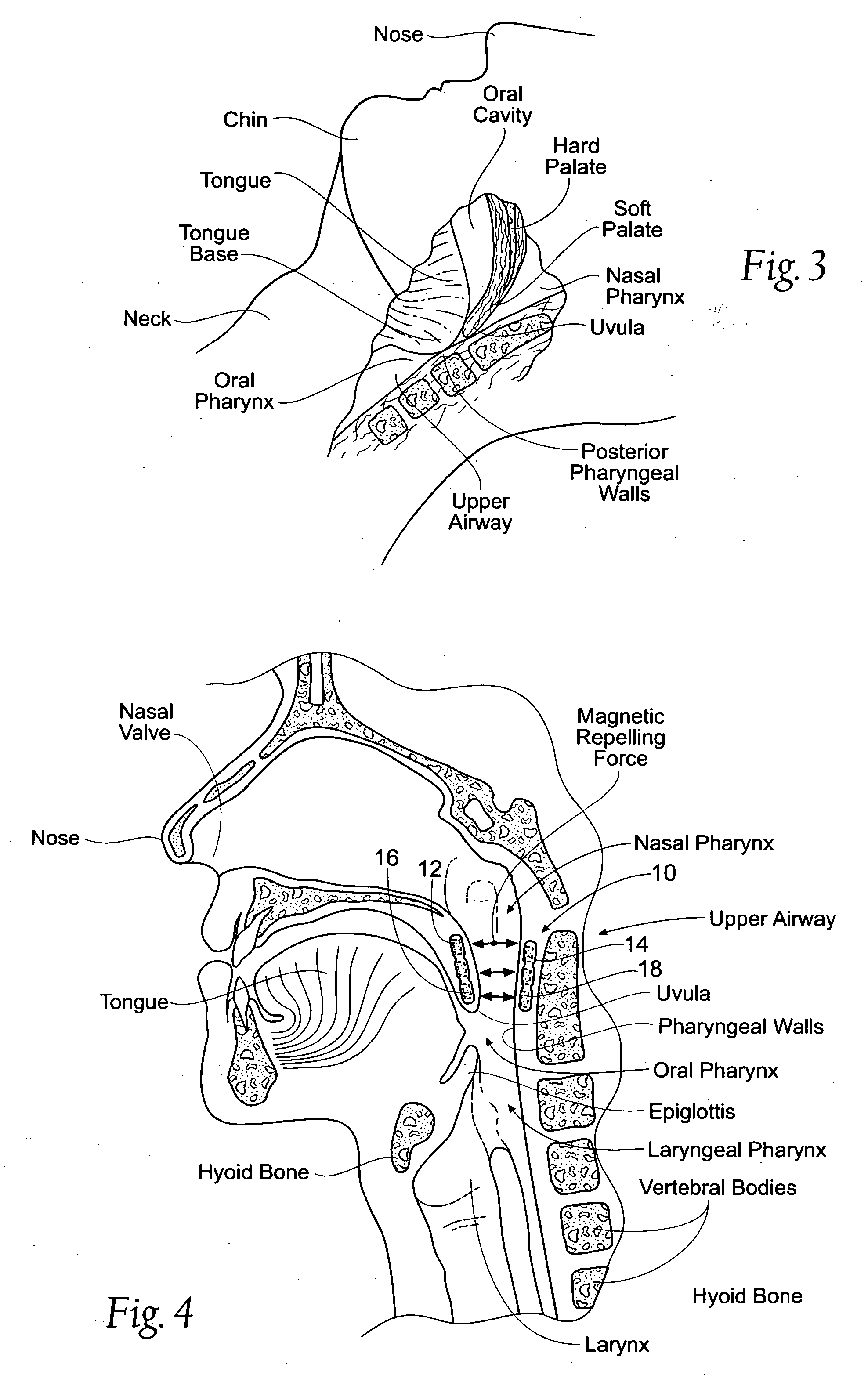 Devices, systems, and methods using magnetic force systems in or on soft palate tissue