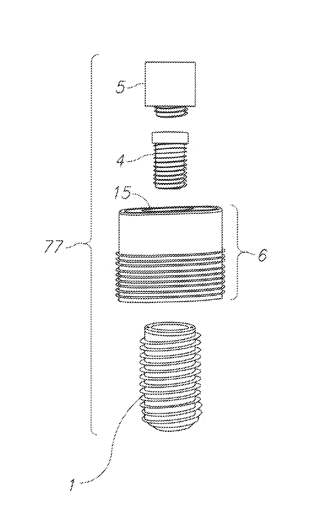 System, method and apparatus for implementing dental implants