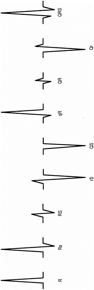 Systems and methods for generating control parameters for cardiac resynchronization therapy using ventricular activation simulation and surface ecg recordings