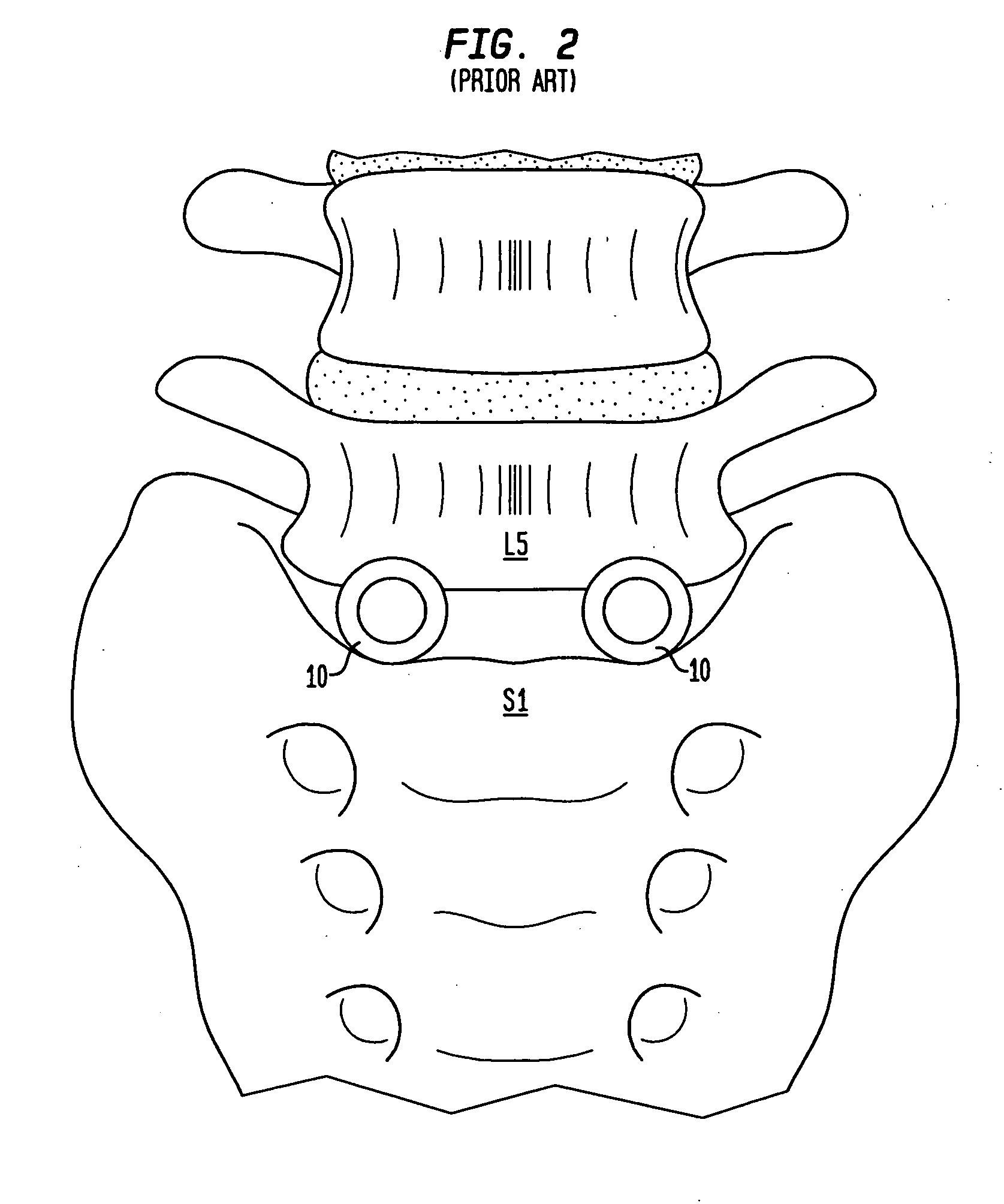 Artificial intervertebral disc having a slotted belleville washer force restoring element