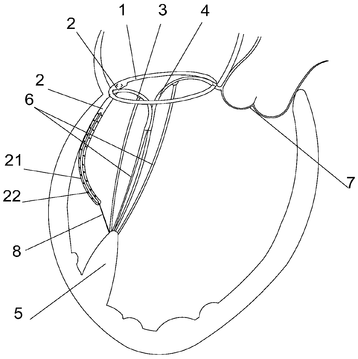 Multifunctional mitral valve shaping device