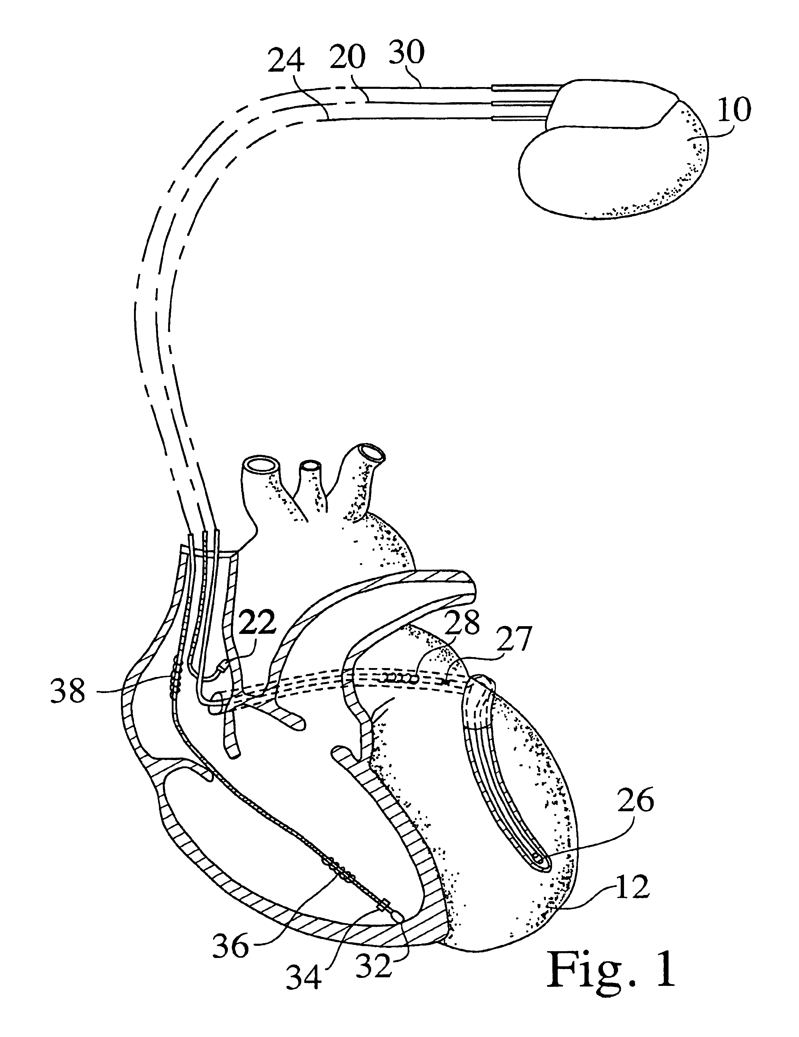 Methods and devices for inhibiting battery voltage delays in an implantable cardiac device