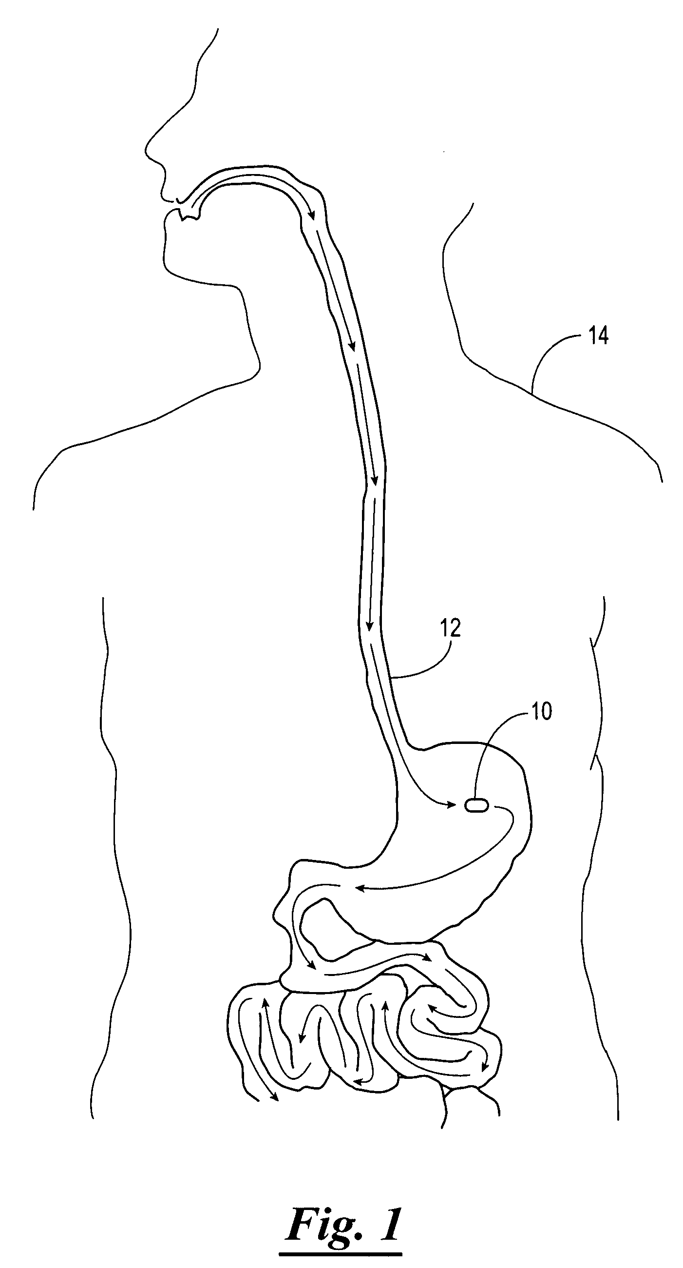 Gastrointestinal stimulator device for digestive and eating disorders