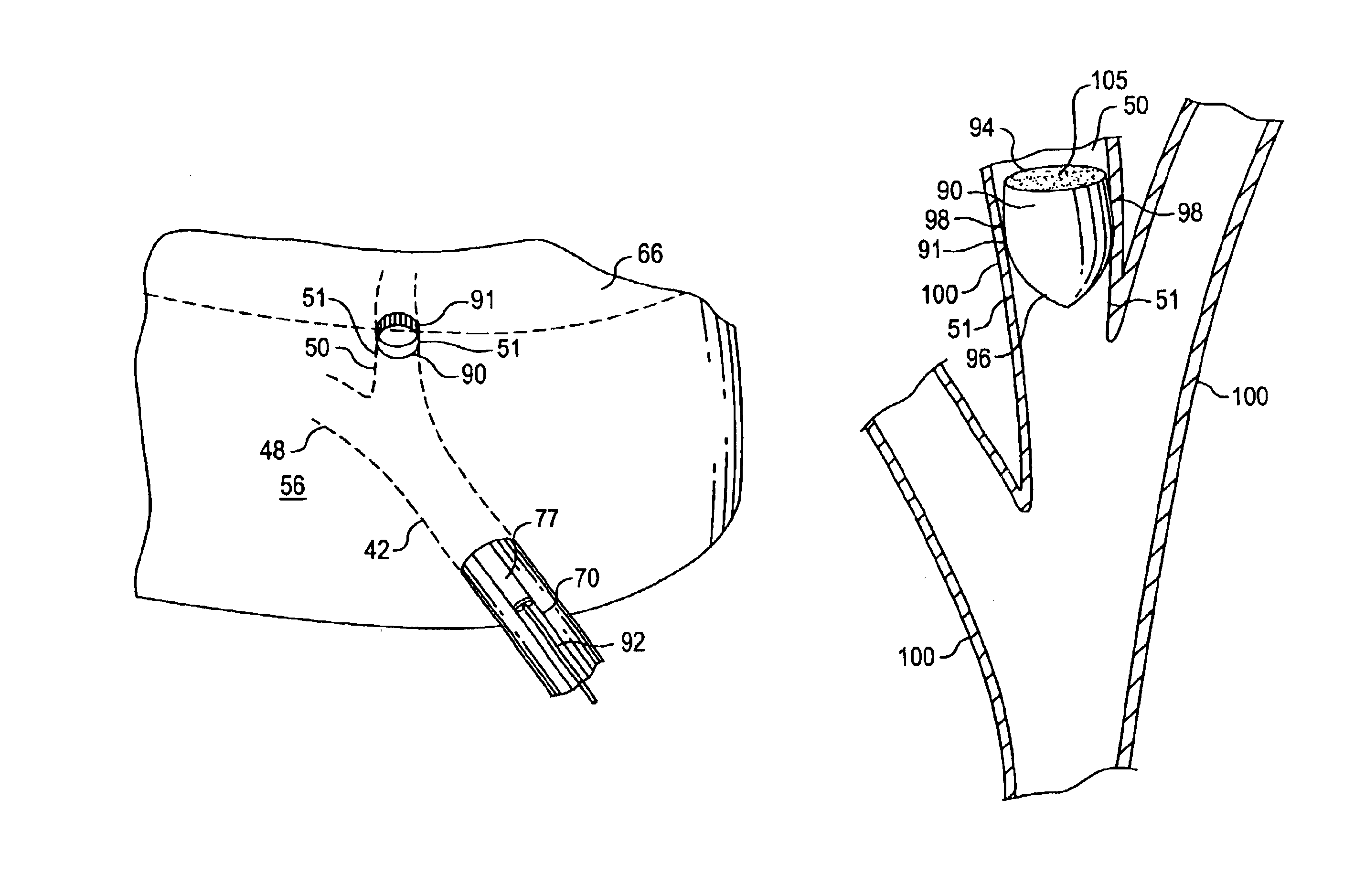 Device and method for intra-bronchial provision of a therapeutic agent