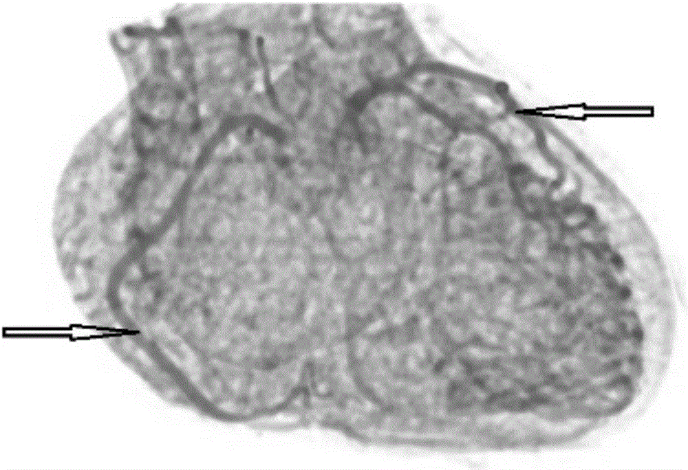 Full-automatic coronary artery segmentation method