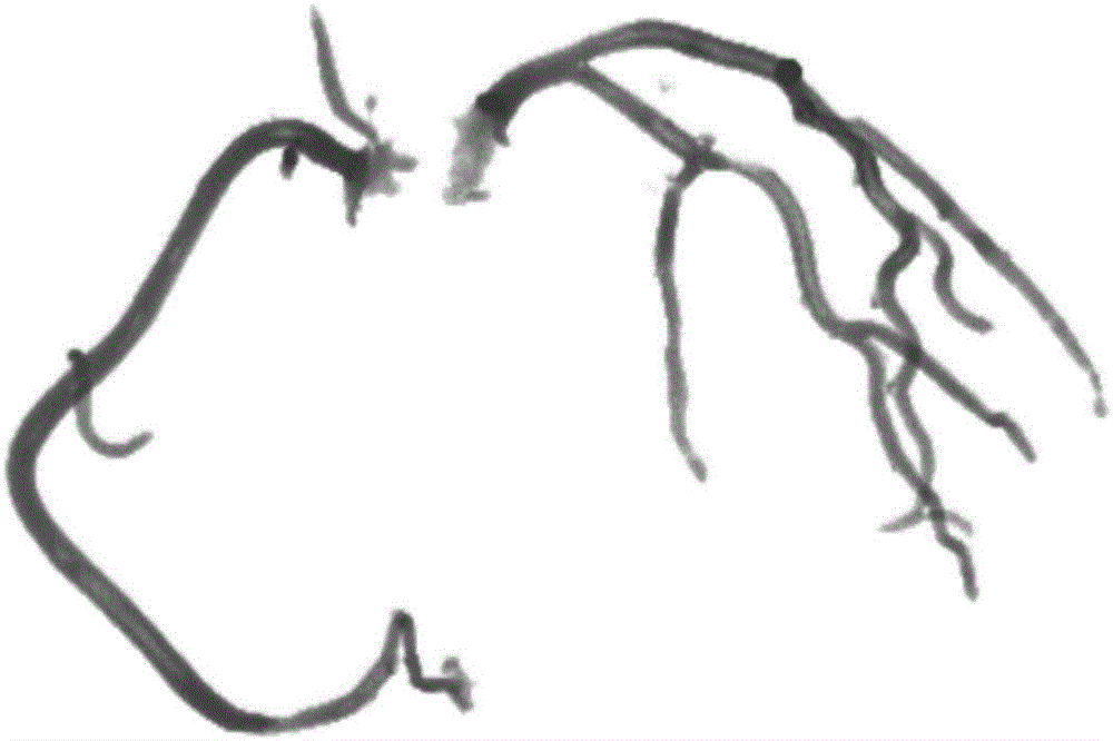 Full-automatic coronary artery segmentation method