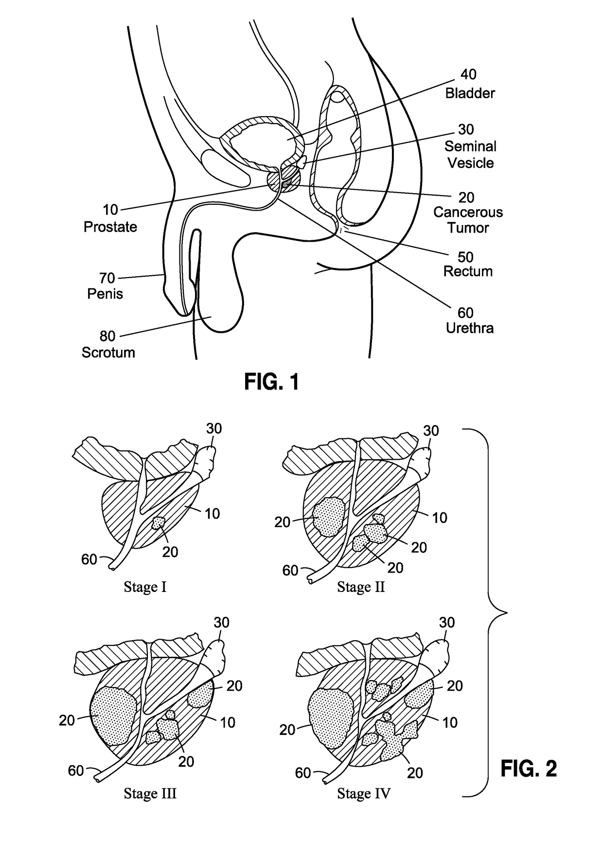 Prostatic liquid biopsy for the detection of prostate cancer and benign prostatic hyperplasia