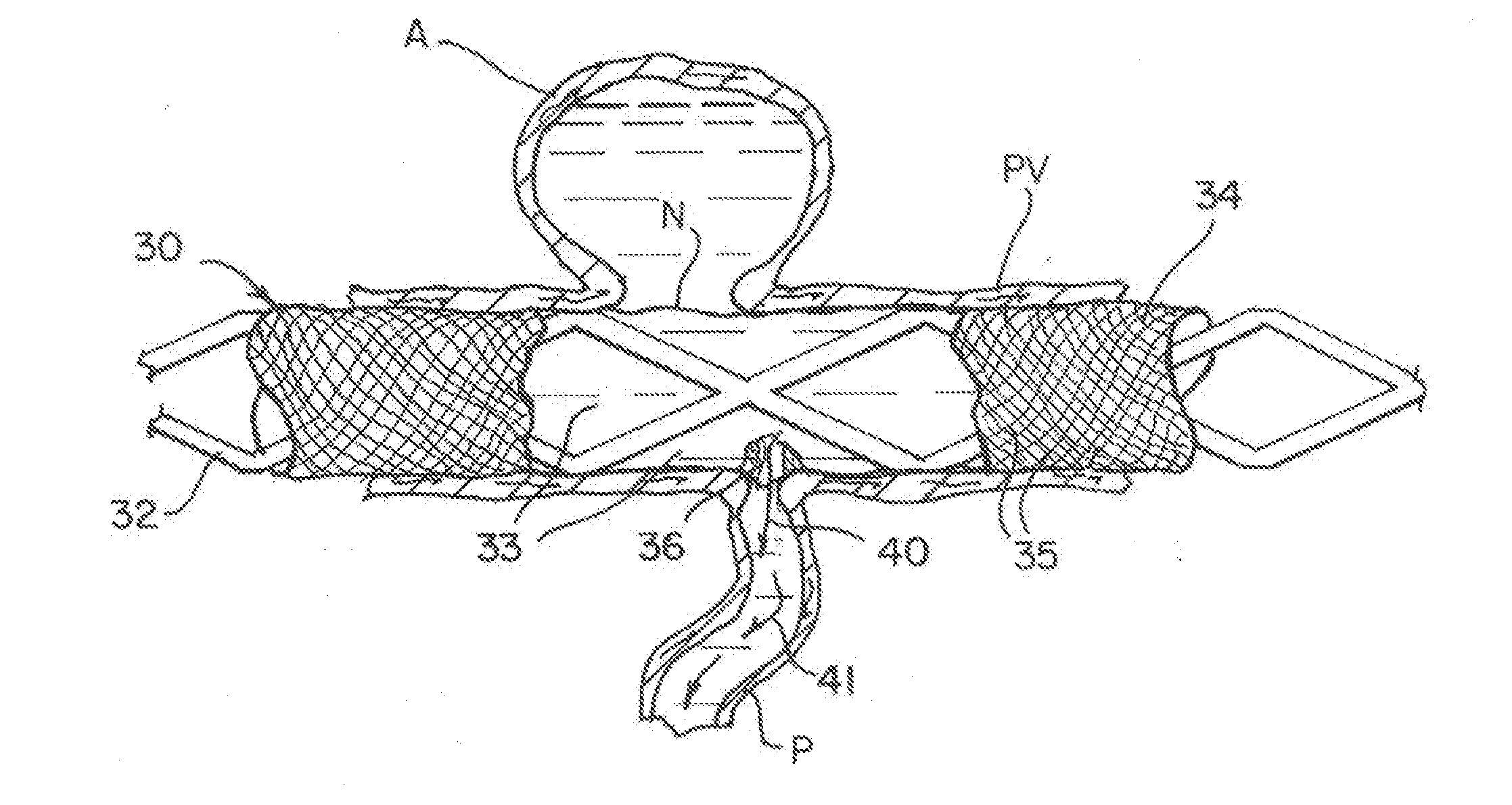 Modifiable occlusion device