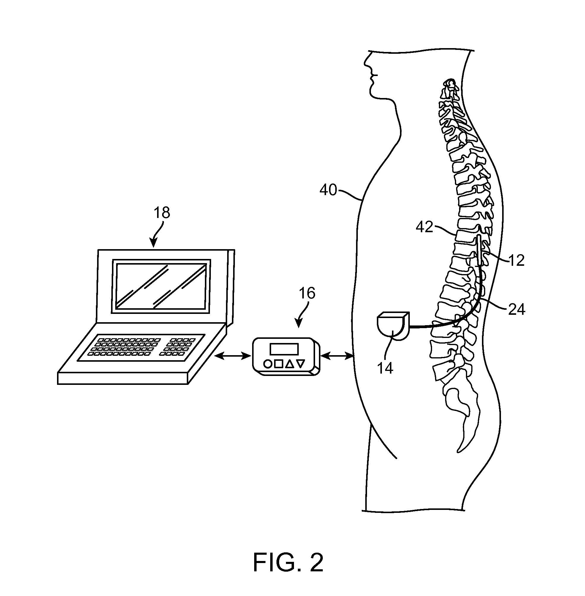 Method for epidural stimulation of neural structures