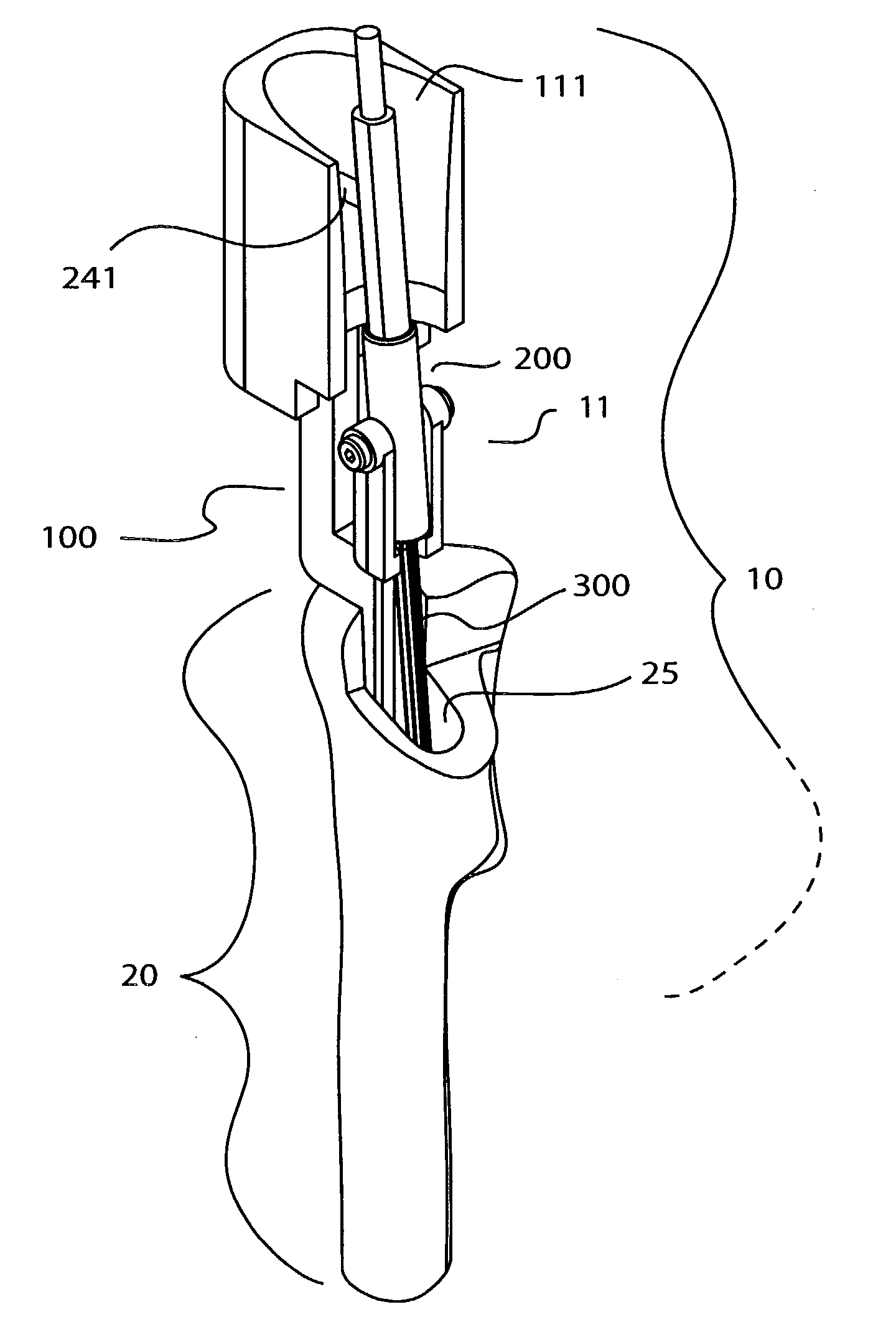 Surgical milling instrument for shaping a bone cavity