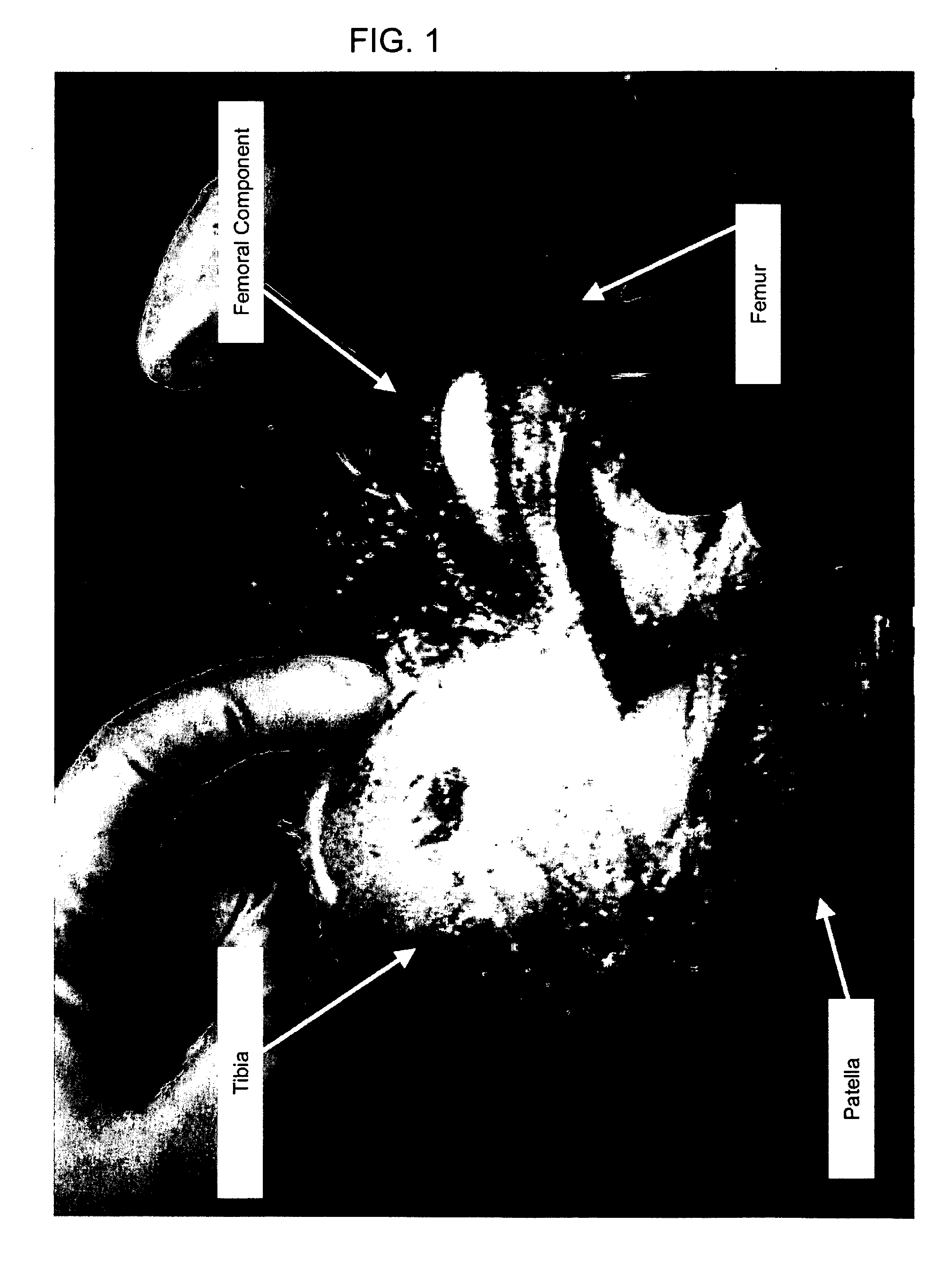 Methods and apparatus for minimally invasive arthroplasty