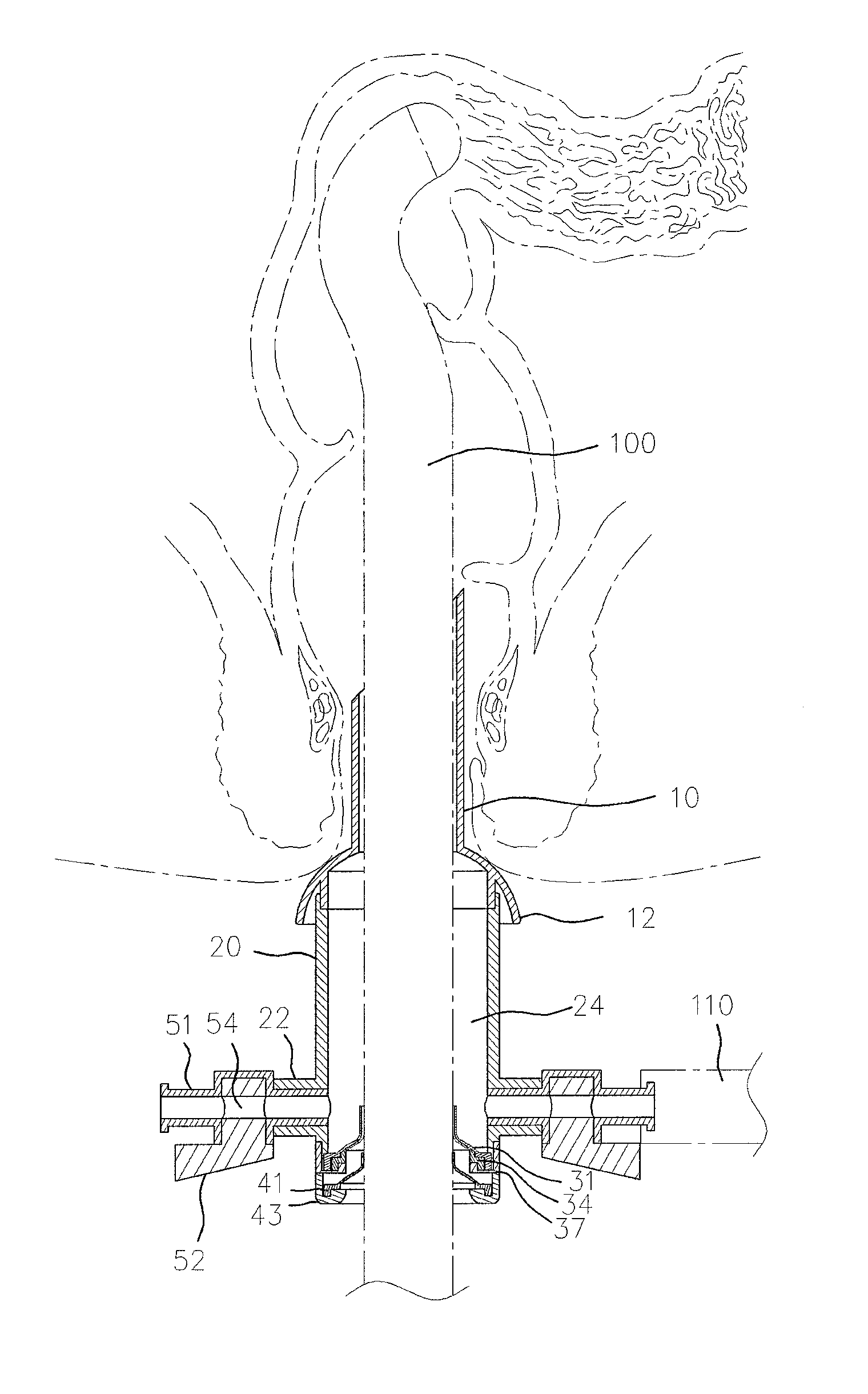 Auxiliary tool for colonoscopy