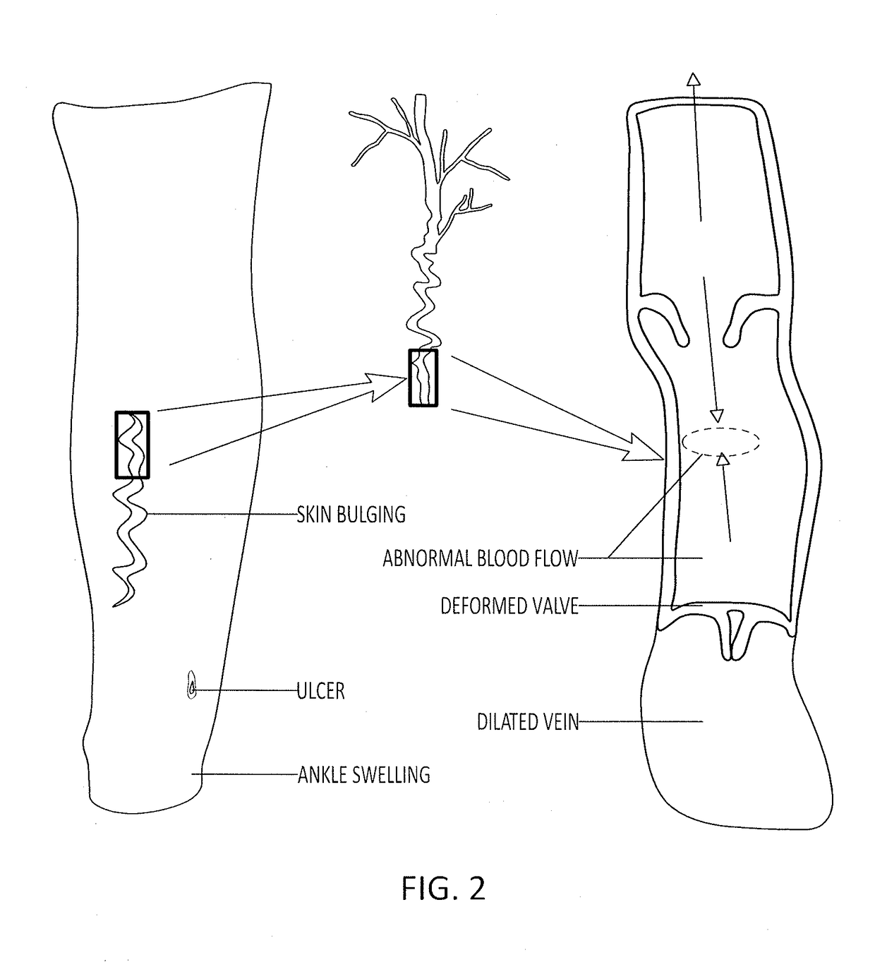 Adaptive compression therapy systems and methods