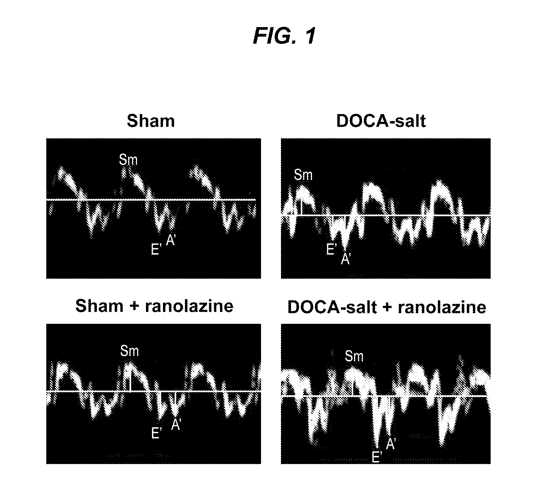 Methods of treating diastolic dysfunction and related conditions