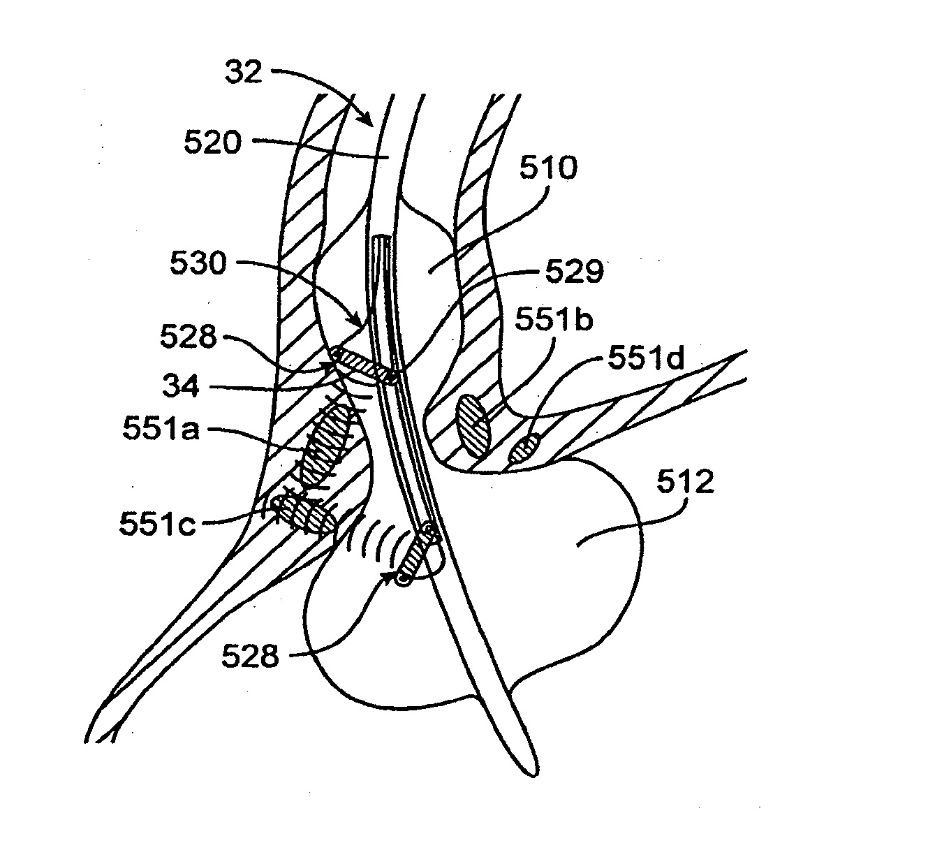 Intraluminal methods of ablating nerve tissue
