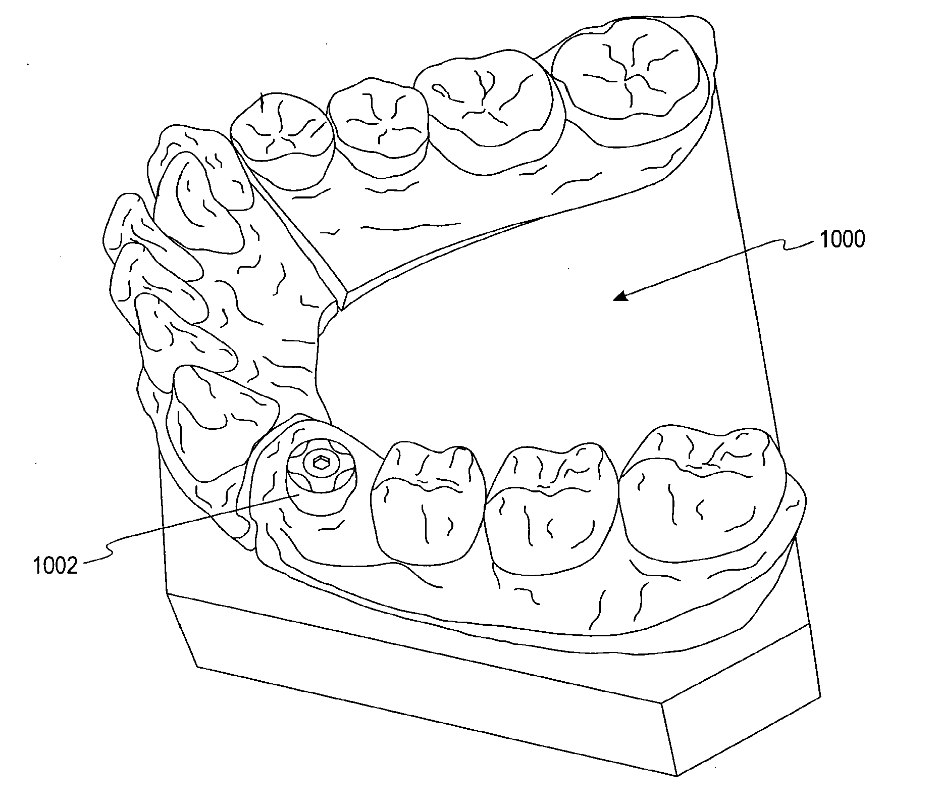 Methods For Manufacturing Dental Implant Components