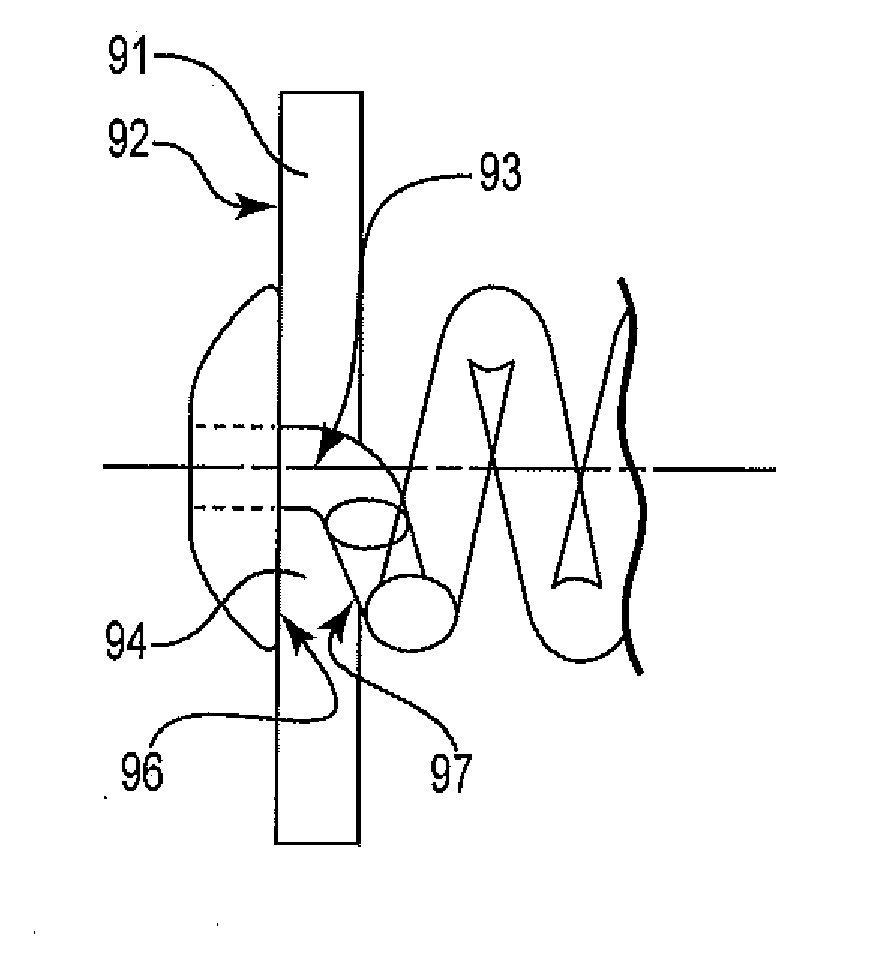 Implantable ocular drug delivery device and methods