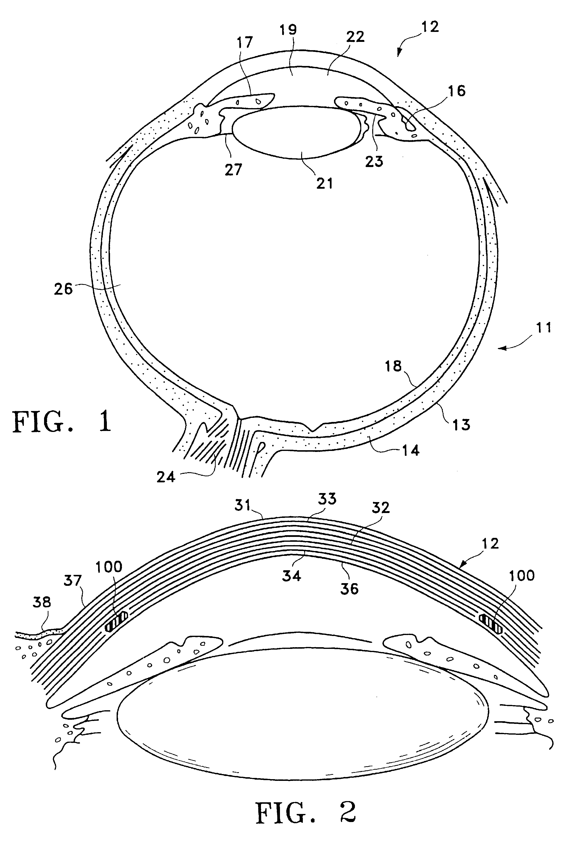 Device and method for inserting a biocompatible material into the corneal stroma