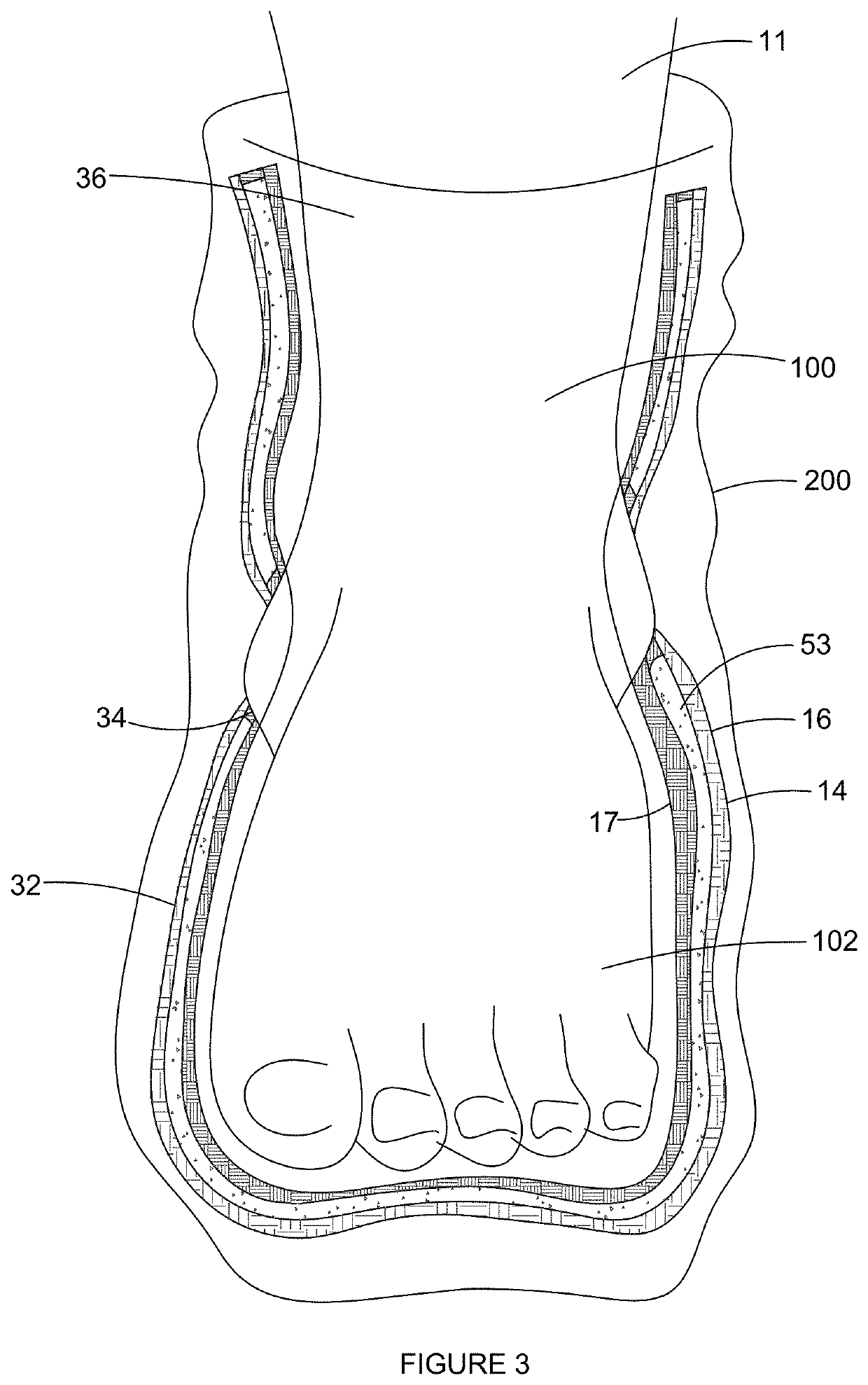 Distributive Foot Sleeve for Relieving Pressure in a Ski Boots and the Like