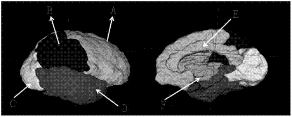 Quantitative calculation method for automatic regional brain shrinkage degree