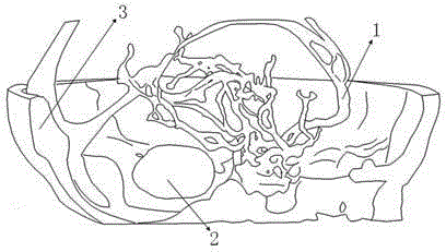 Intracranial tumor operation planning and simulating method based on 3D print technology