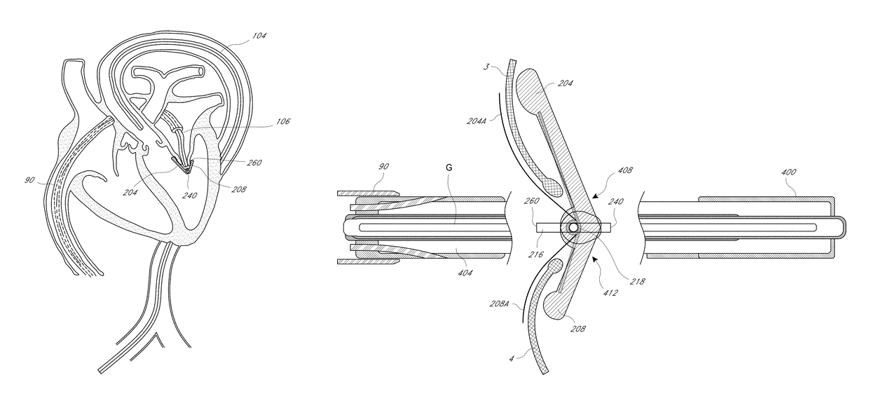 Method and apparatus for percutaneous delivery and deployment of a cardiovascular prosthesis