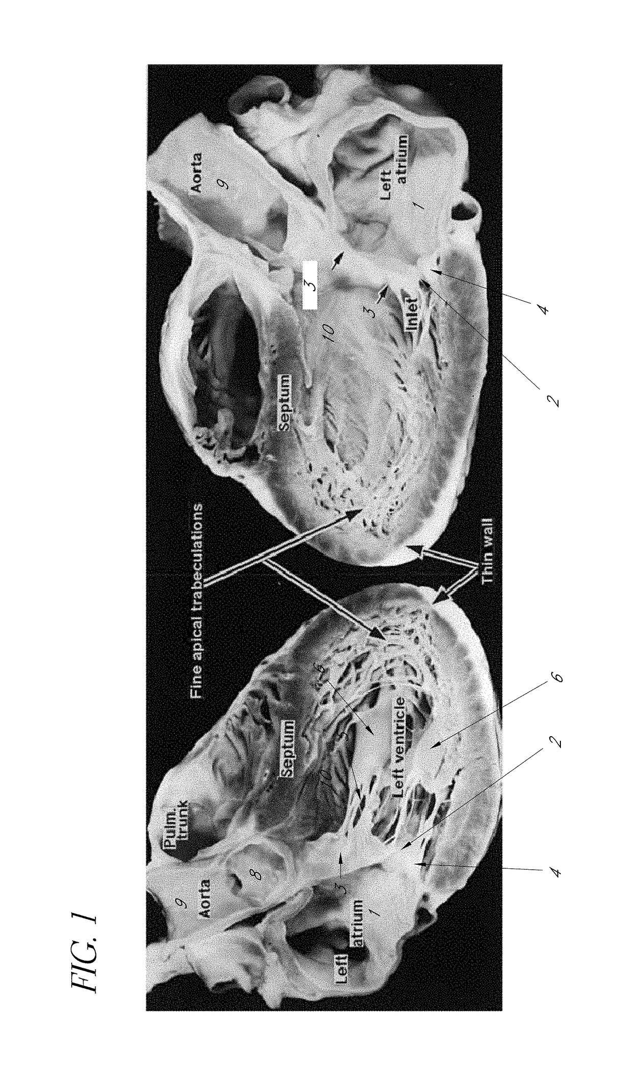 Method and apparatus for percutaneous delivery and deployment of a cardiovascular prosthesis