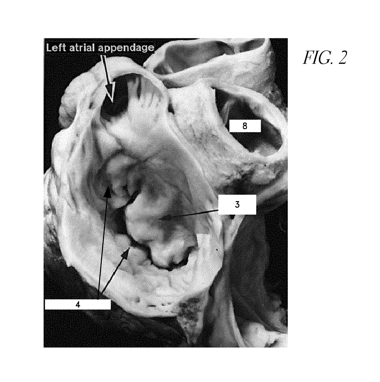 Method and apparatus for percutaneous delivery and deployment of a cardiovascular prosthesis