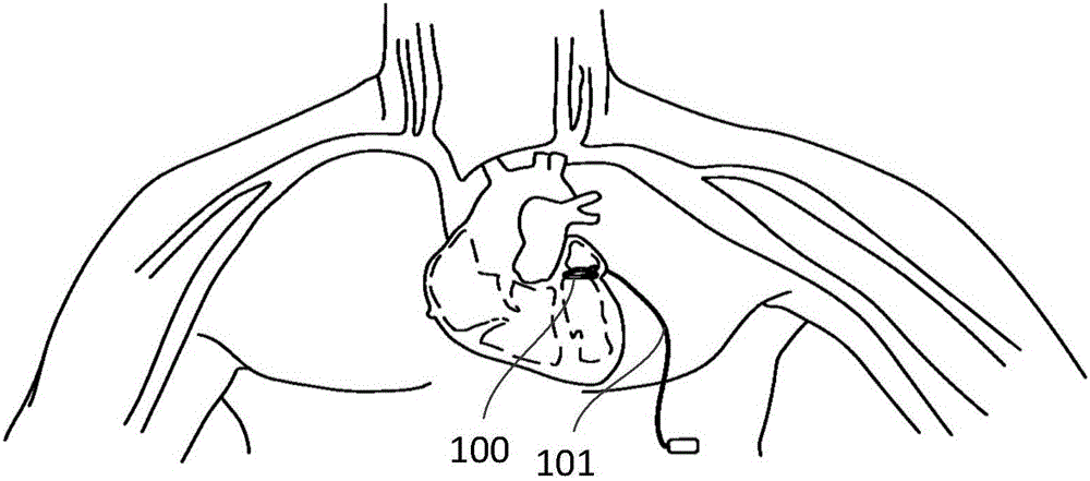 Mitral valve forming ring