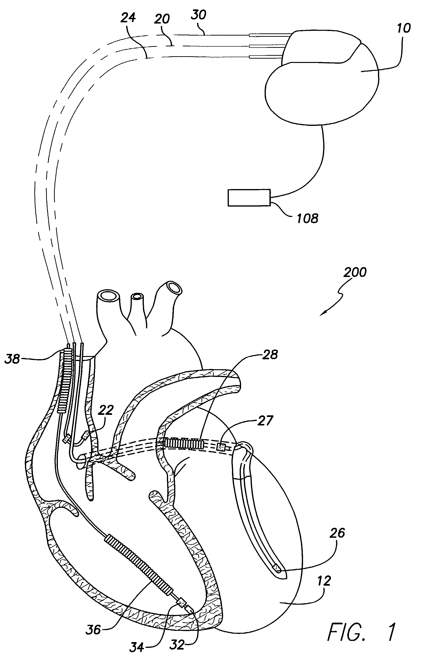 Physician programmer system with telemetered sensor waveform