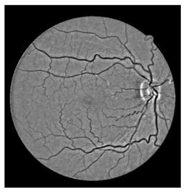 Iterative Fundus Image Vessel Segmentation Method Based on Range Modulation Loss