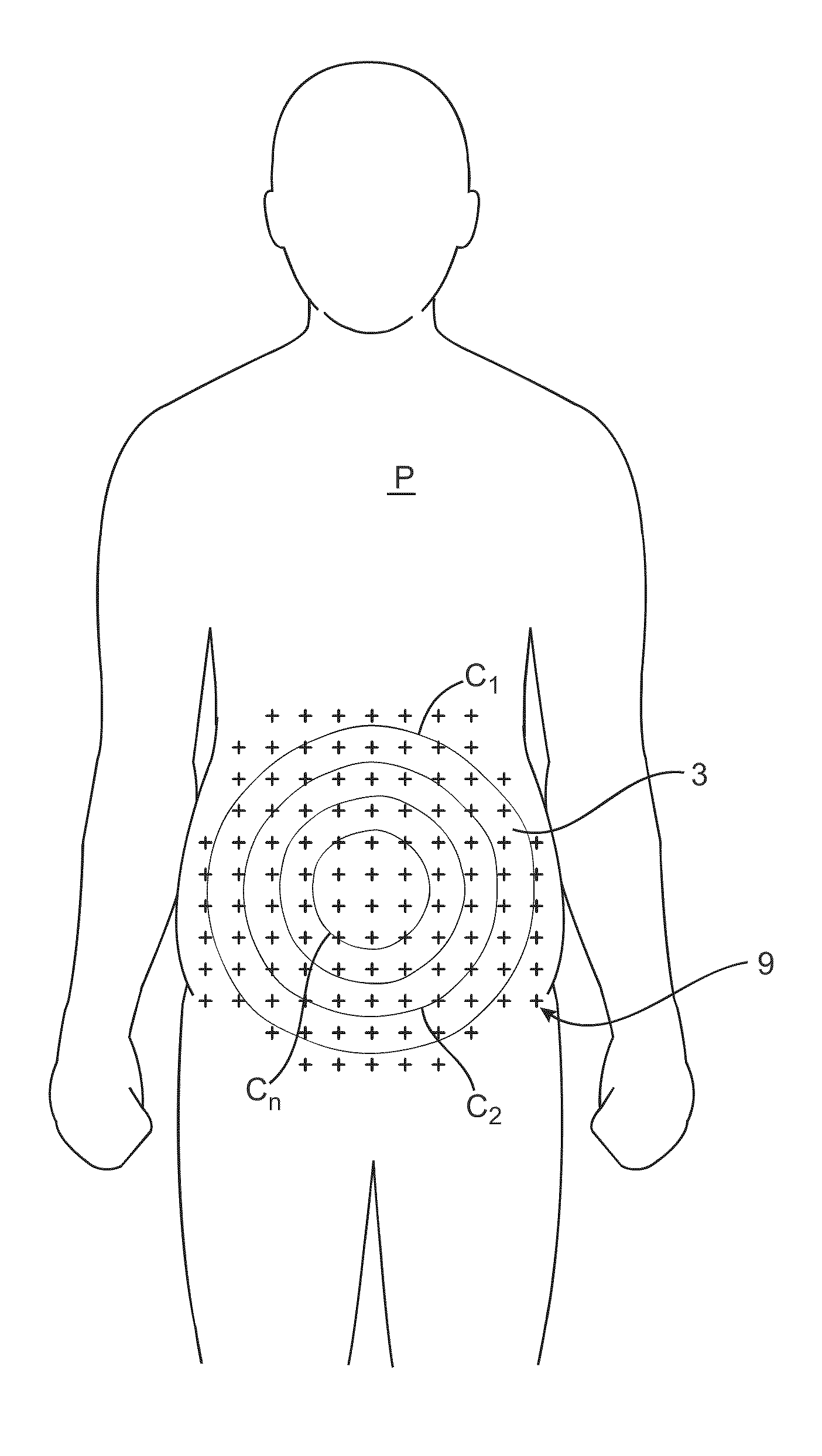 Apparatus and methods for the destruction of adipose tissue