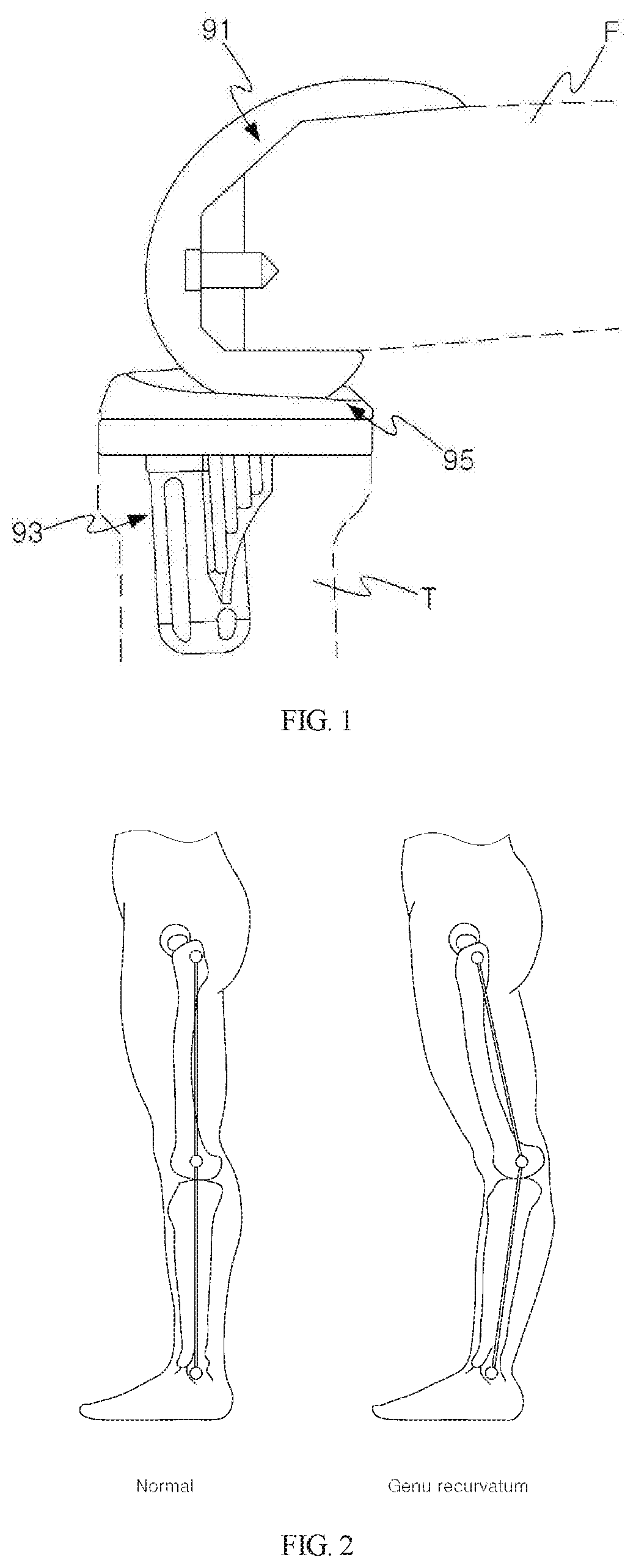 Knee joint implant preventing hyperextension