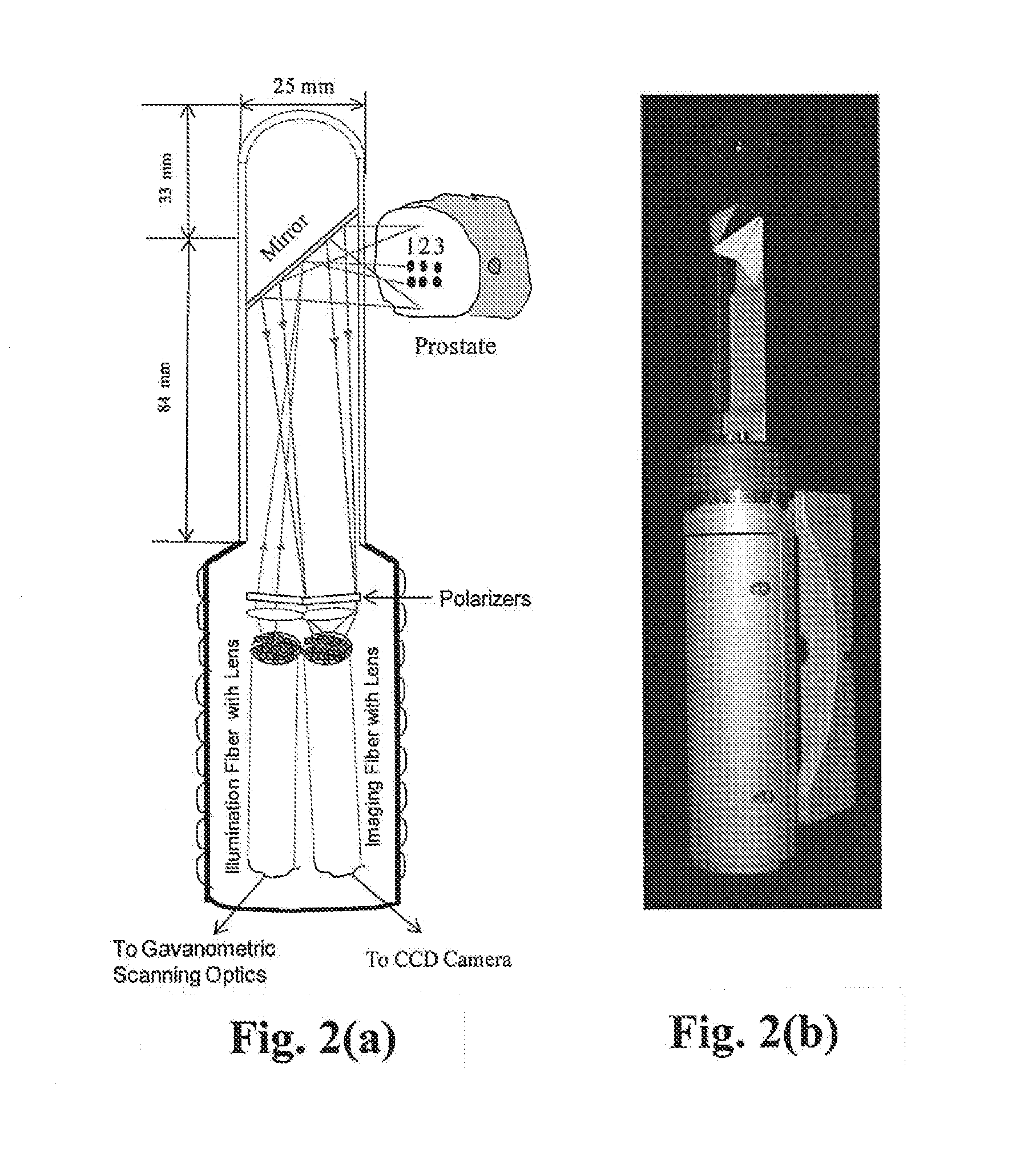 Near infrared photonic prostatoscopy analyzer