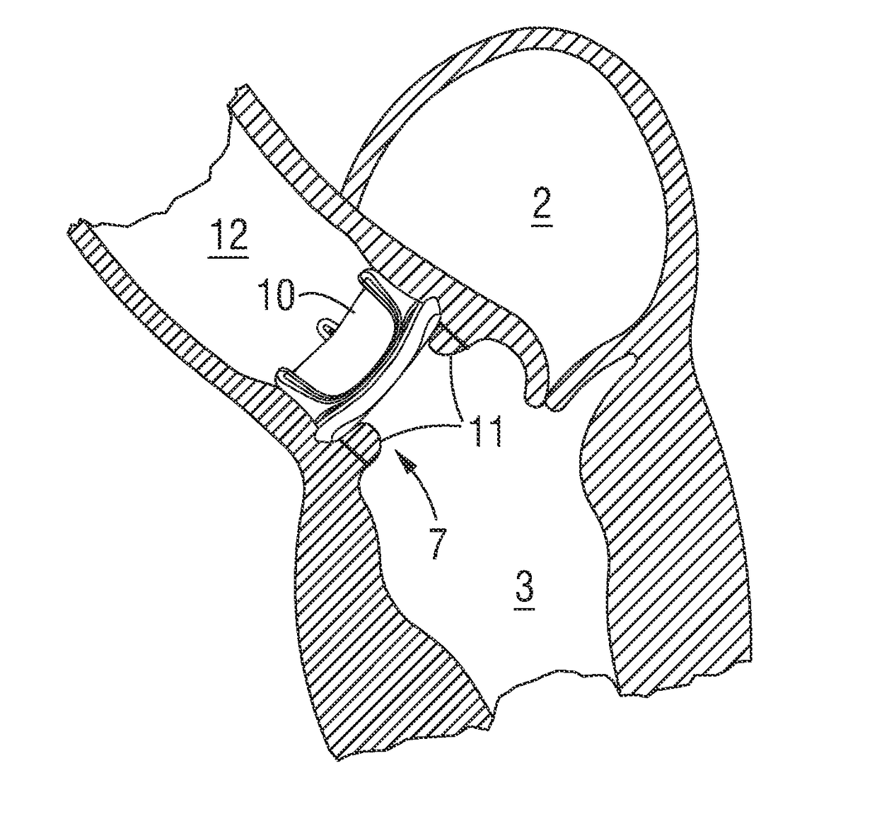 Valve implant with integrated sensor and transmitter