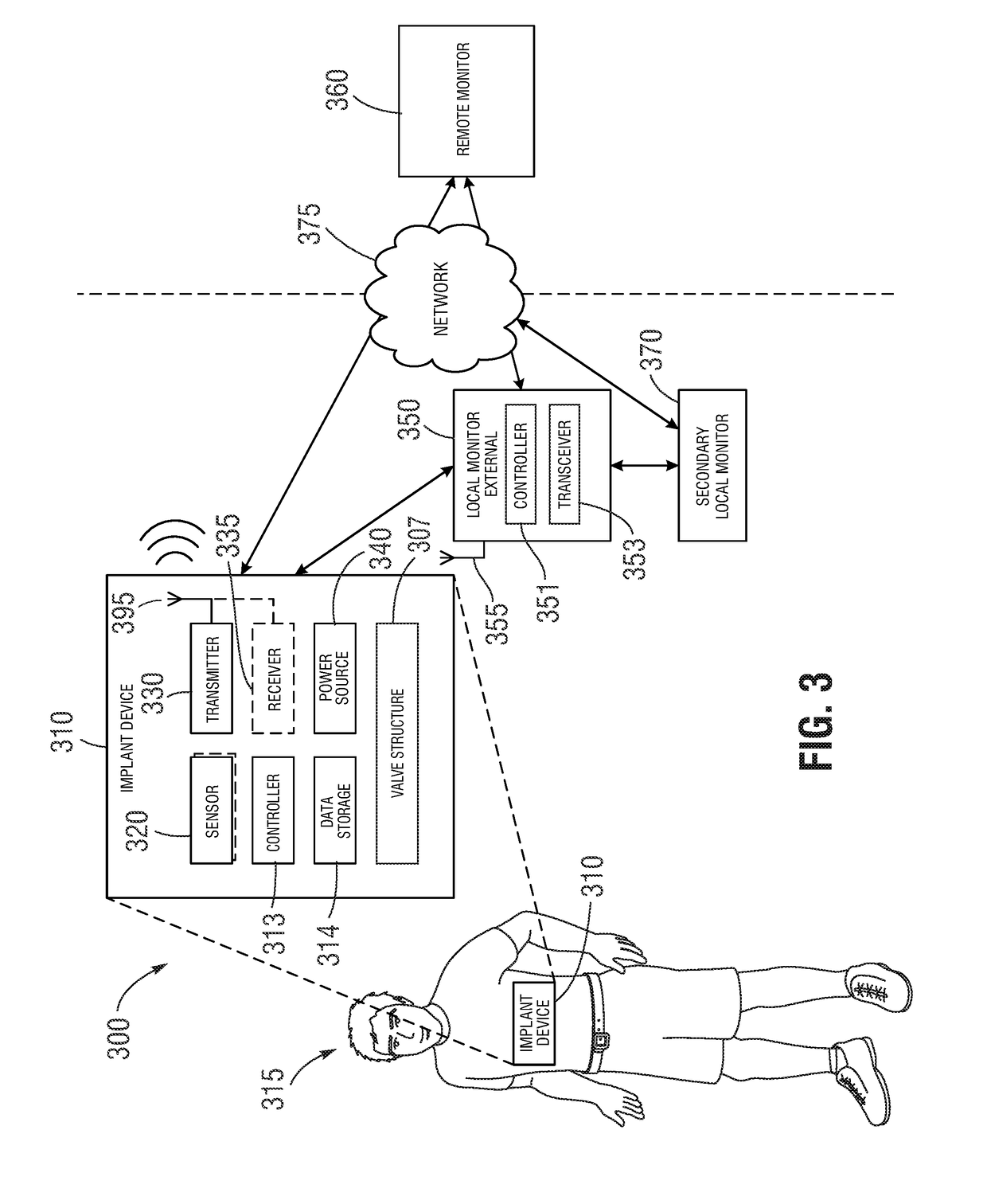 Valve implant with integrated sensor and transmitter