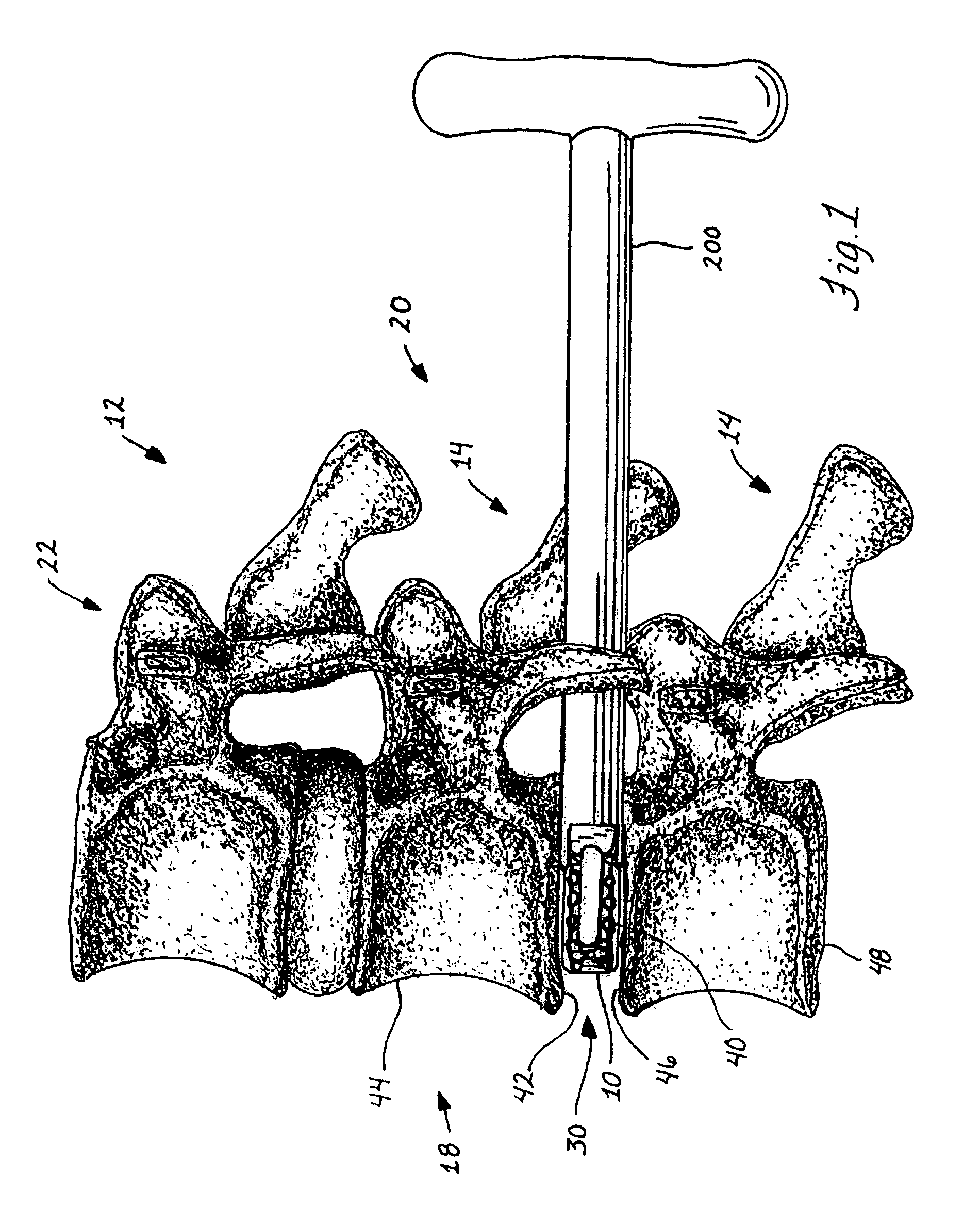 Spinal stabilization device and methods