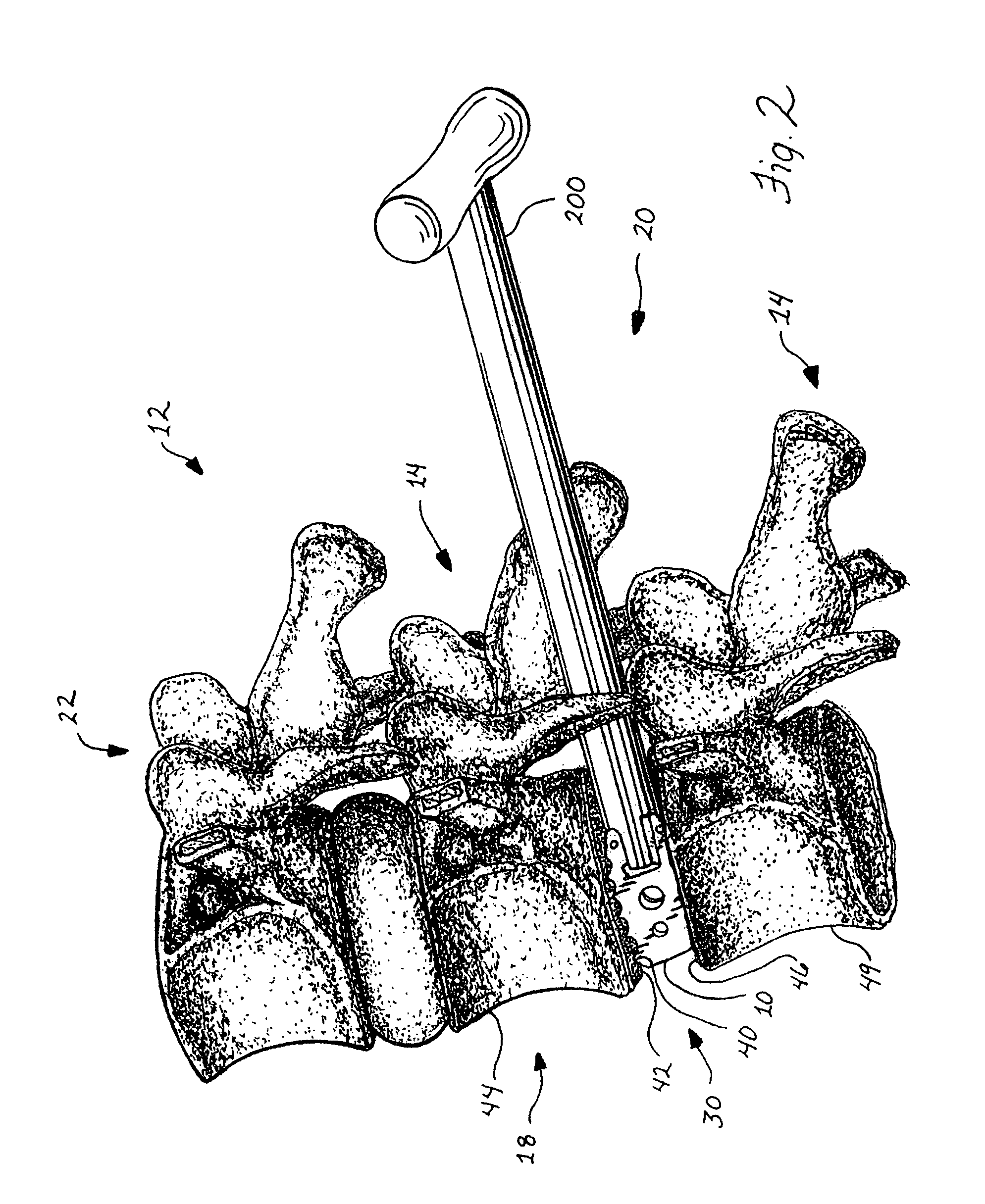 Spinal stabilization device and methods