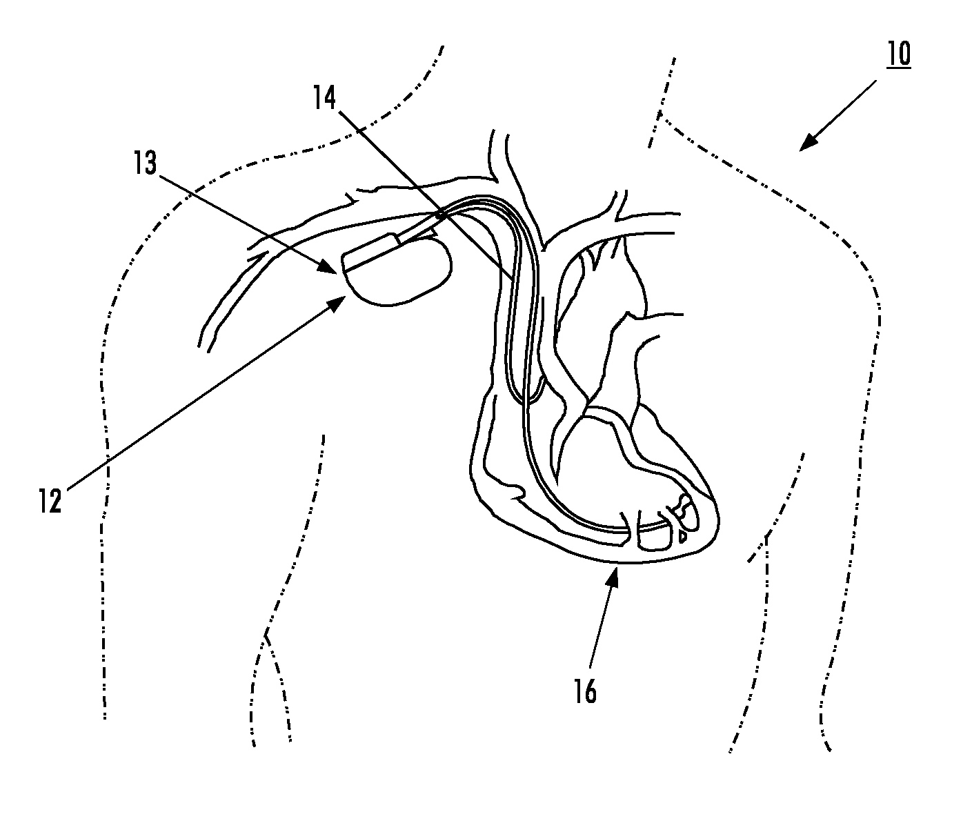 Medical device with an electrically conductive Anti-antenna member